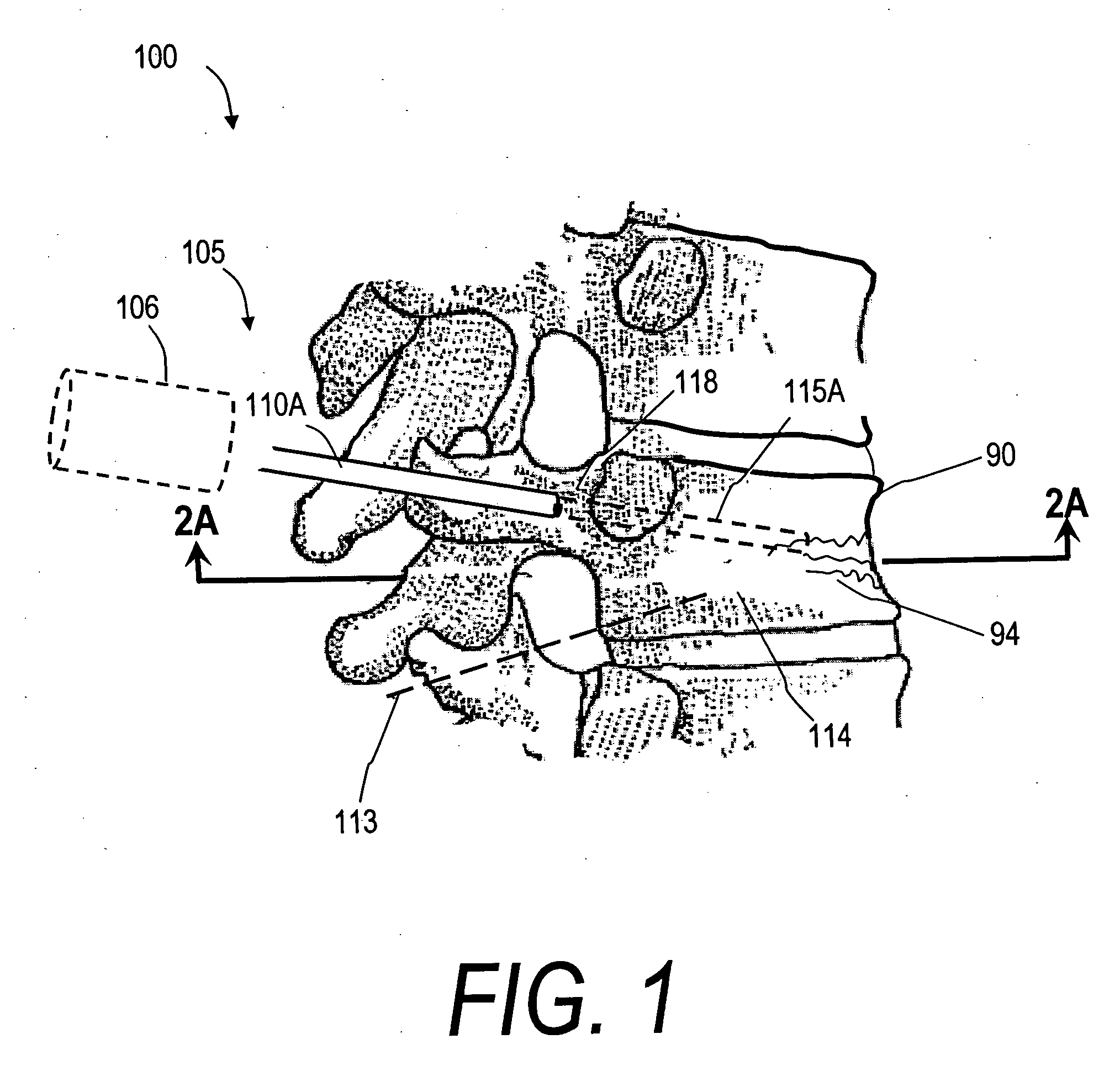 Bone treatment systems and methods