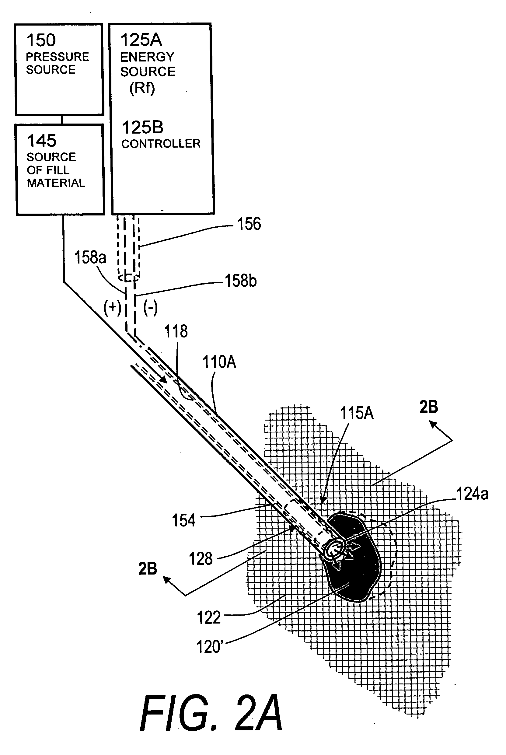 Bone treatment systems and methods