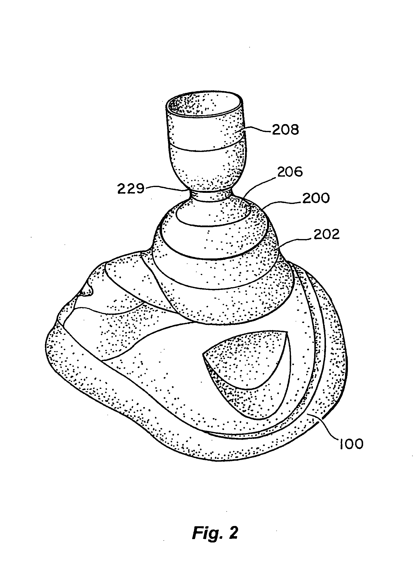 Systems and methods for reducing intracranial pressure