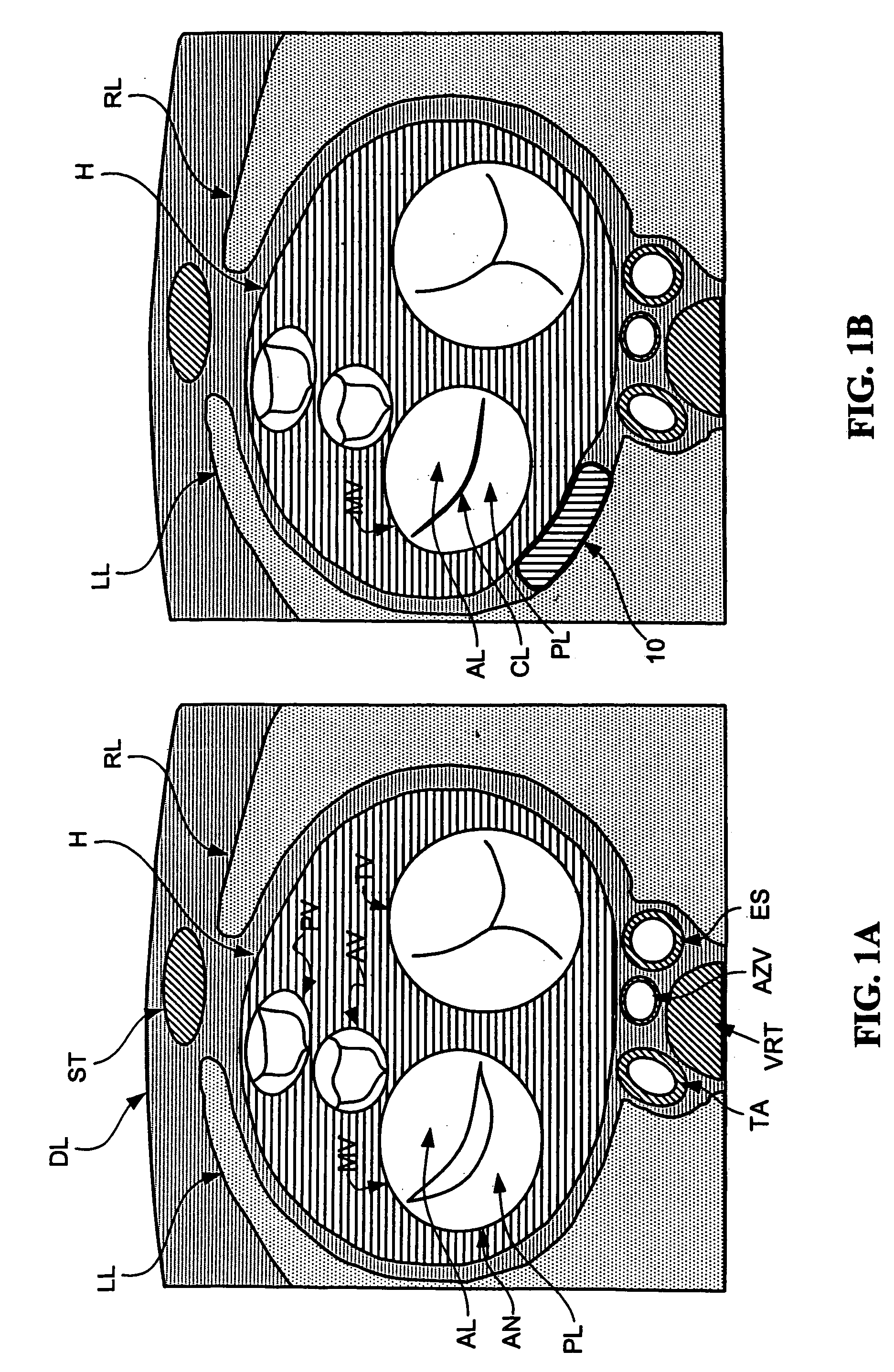 Decives and methods for heart valve treatment