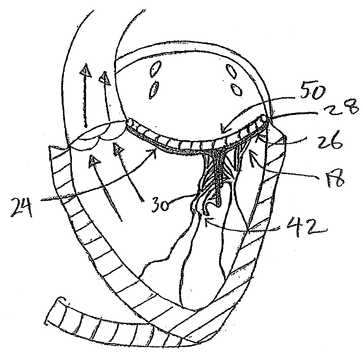 Transvalvular intraannular band for valve repair