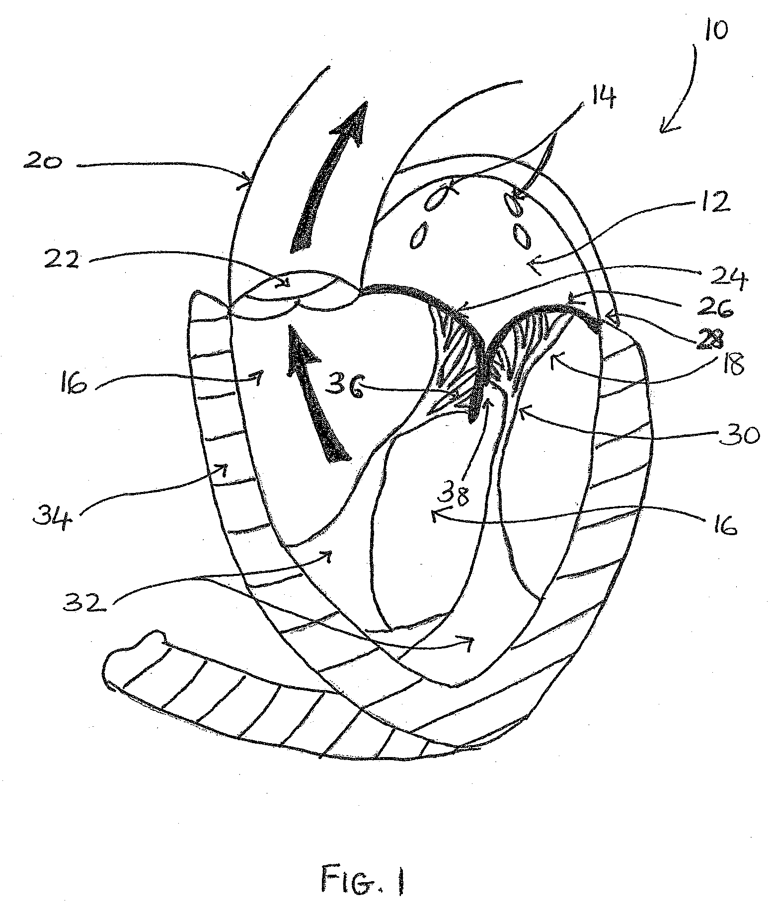 Transvalvular intraannular band for valve repair