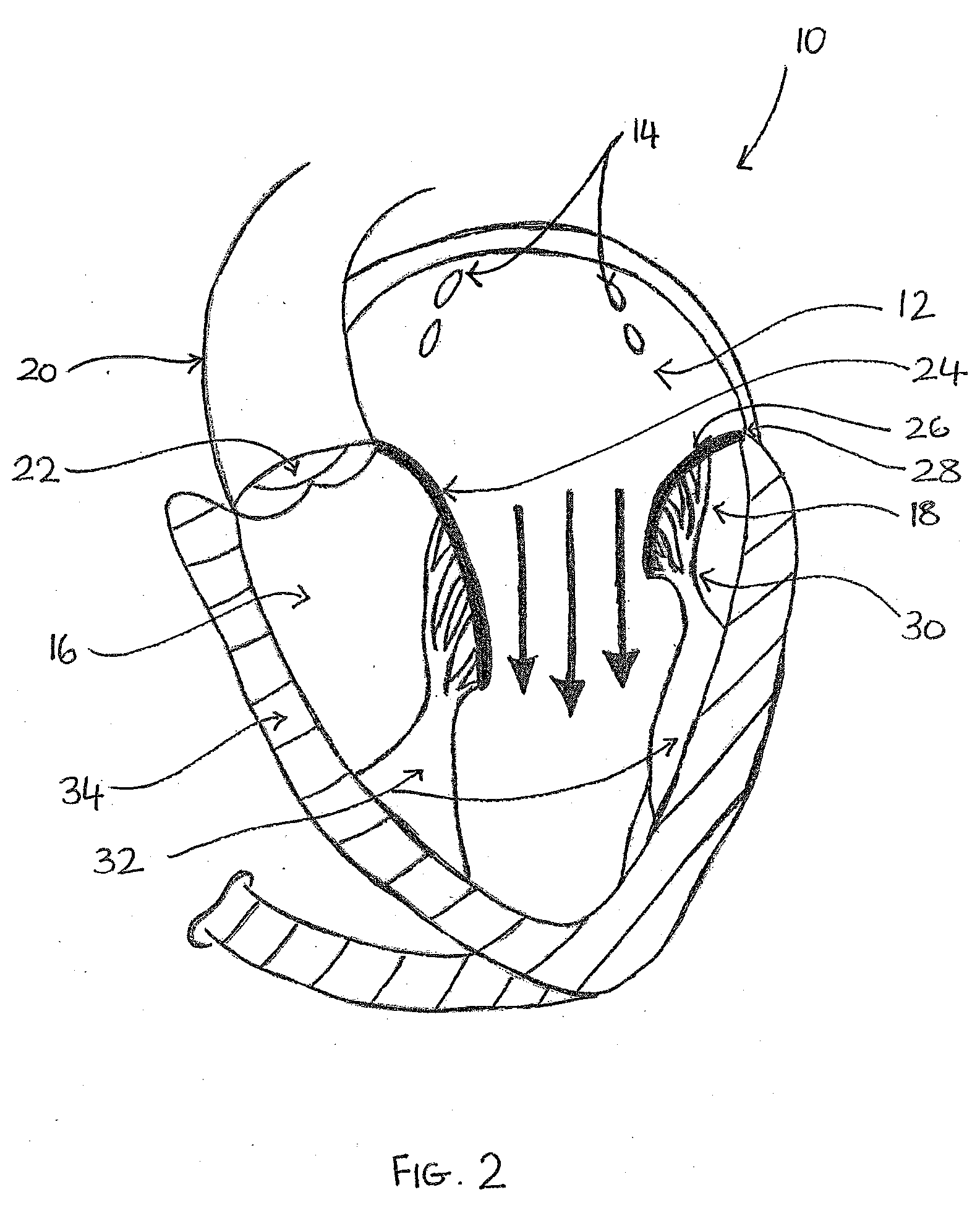 Transvalvular intraannular band for valve repair