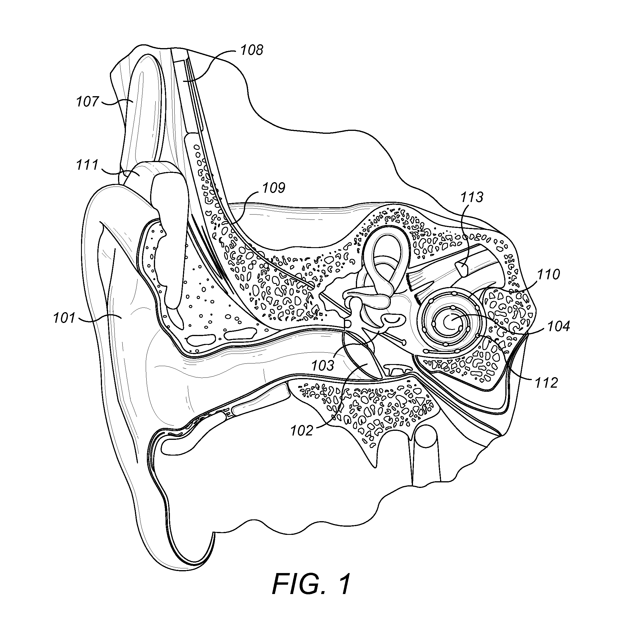 Cochlear Implant Electrode Insertion Bridge