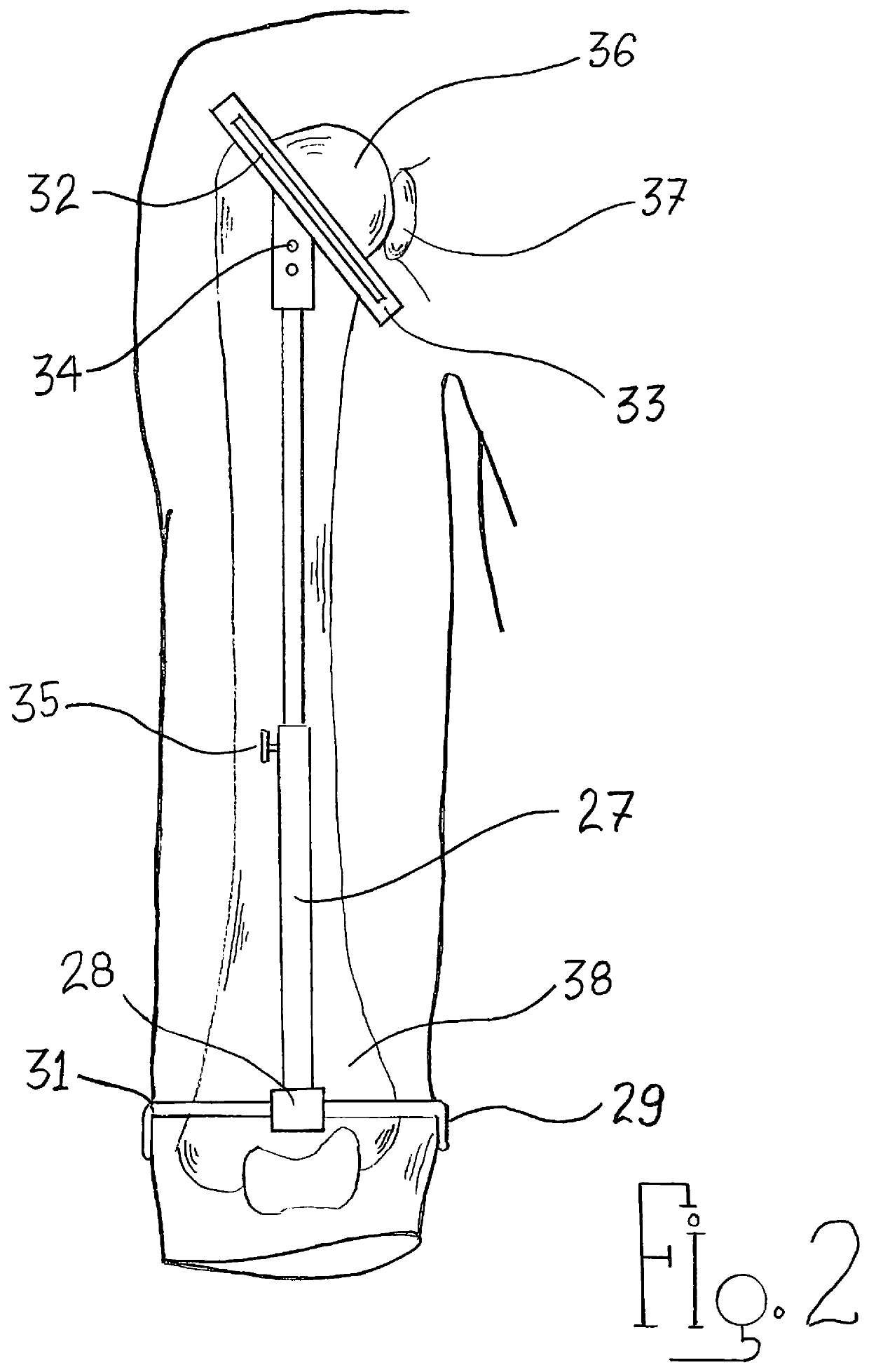 Arthroscopic shoulder arthroplasty and method thereof