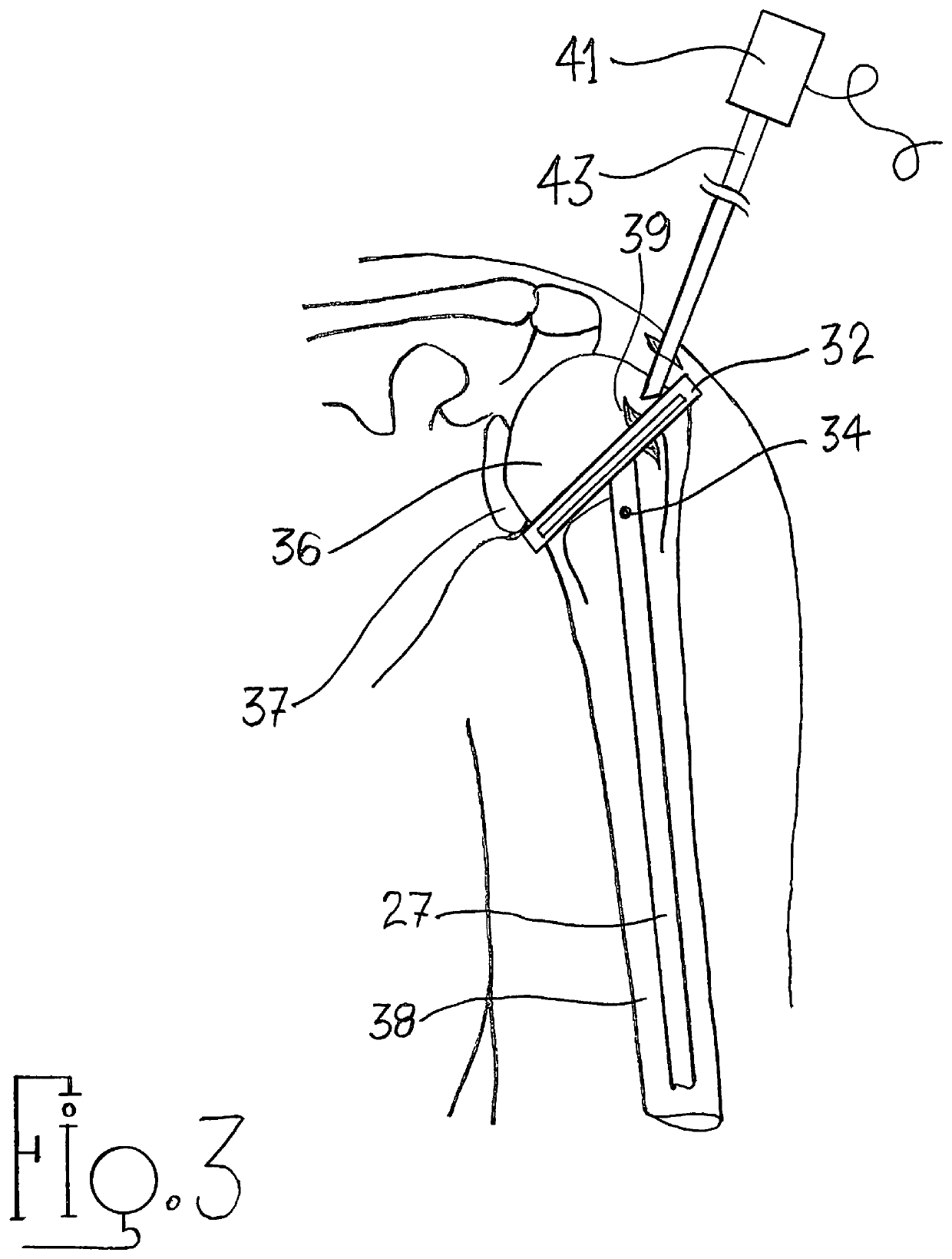 Arthroscopic shoulder arthroplasty and method thereof