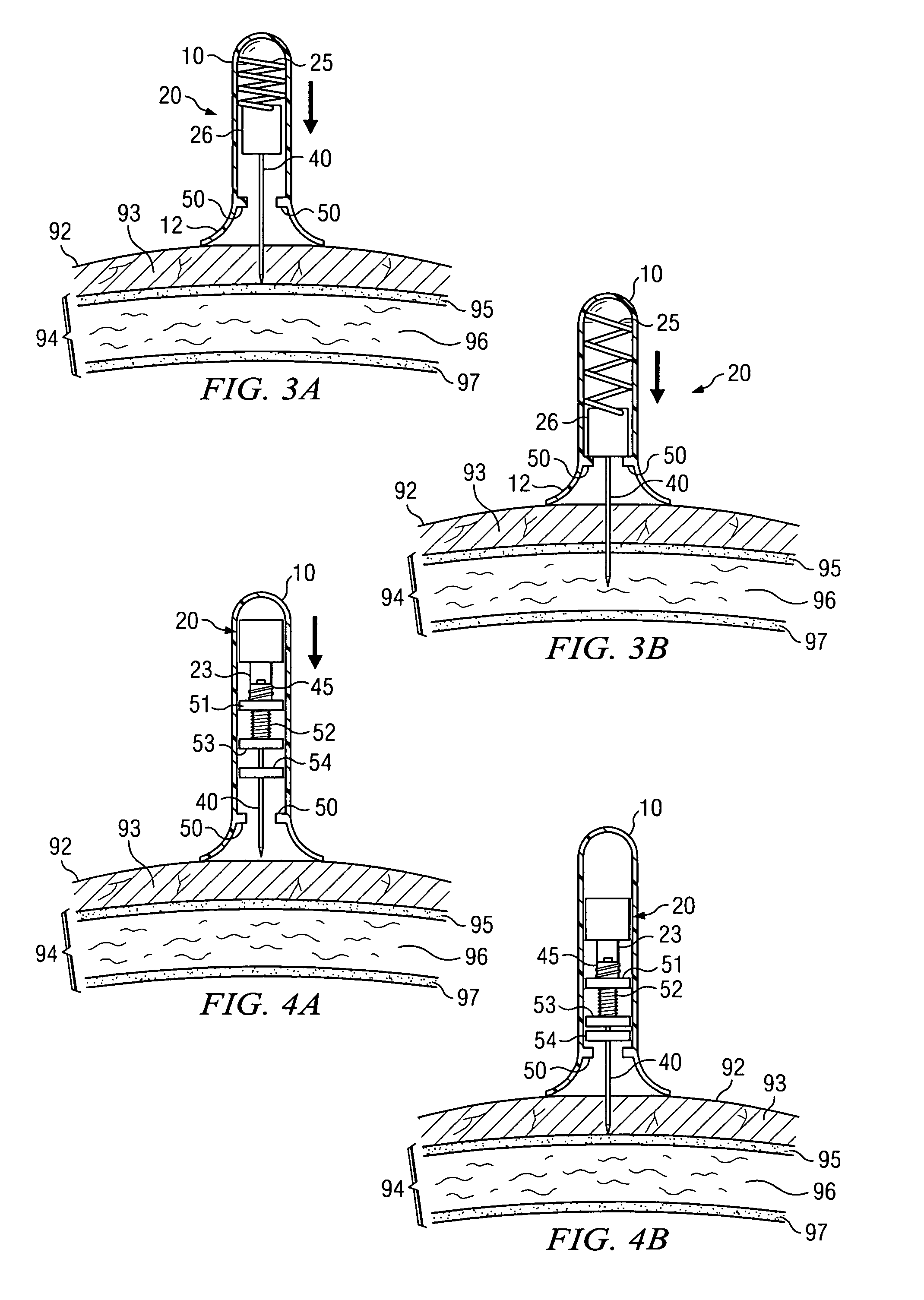 Apparatus and method for accessing the bone marrow of the sternum