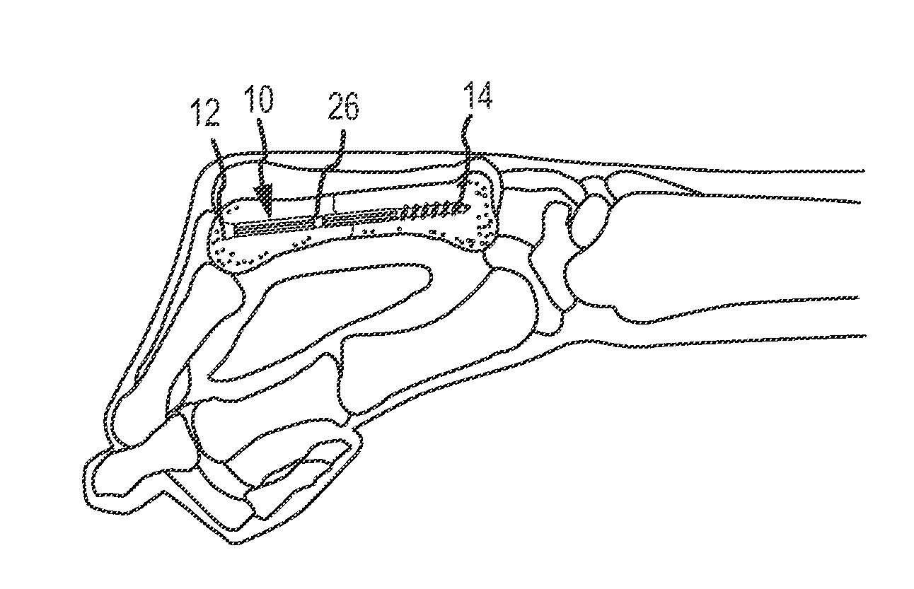 Metacarpal bone stabilization device