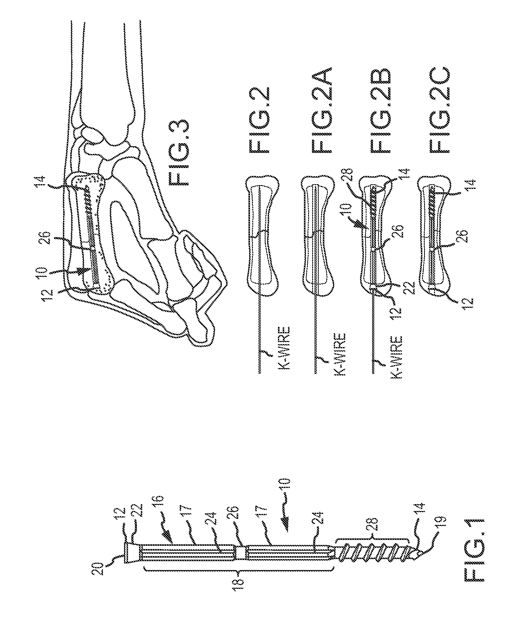 Metacarpal bone stabilization device