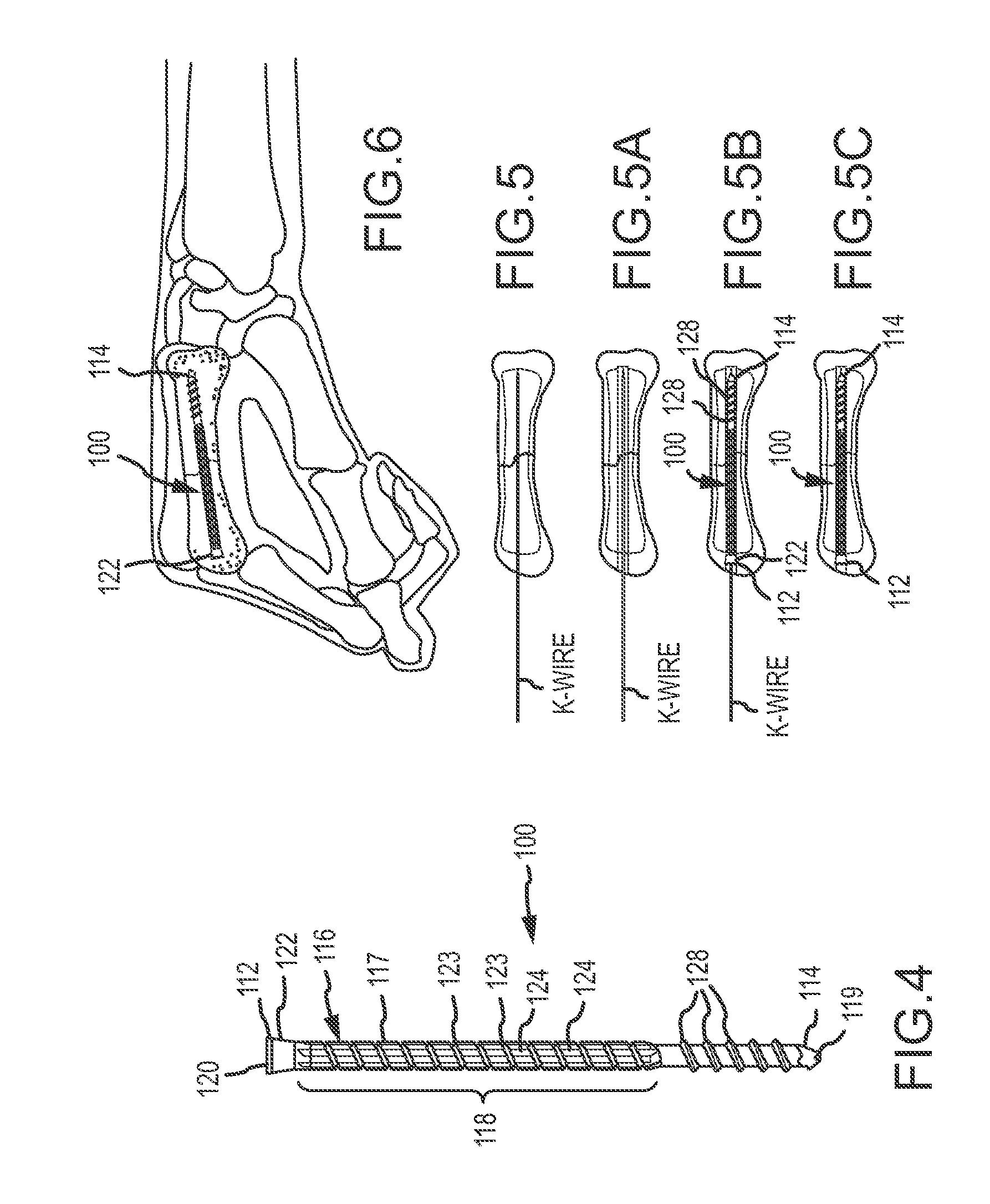 Metacarpal bone stabilization device