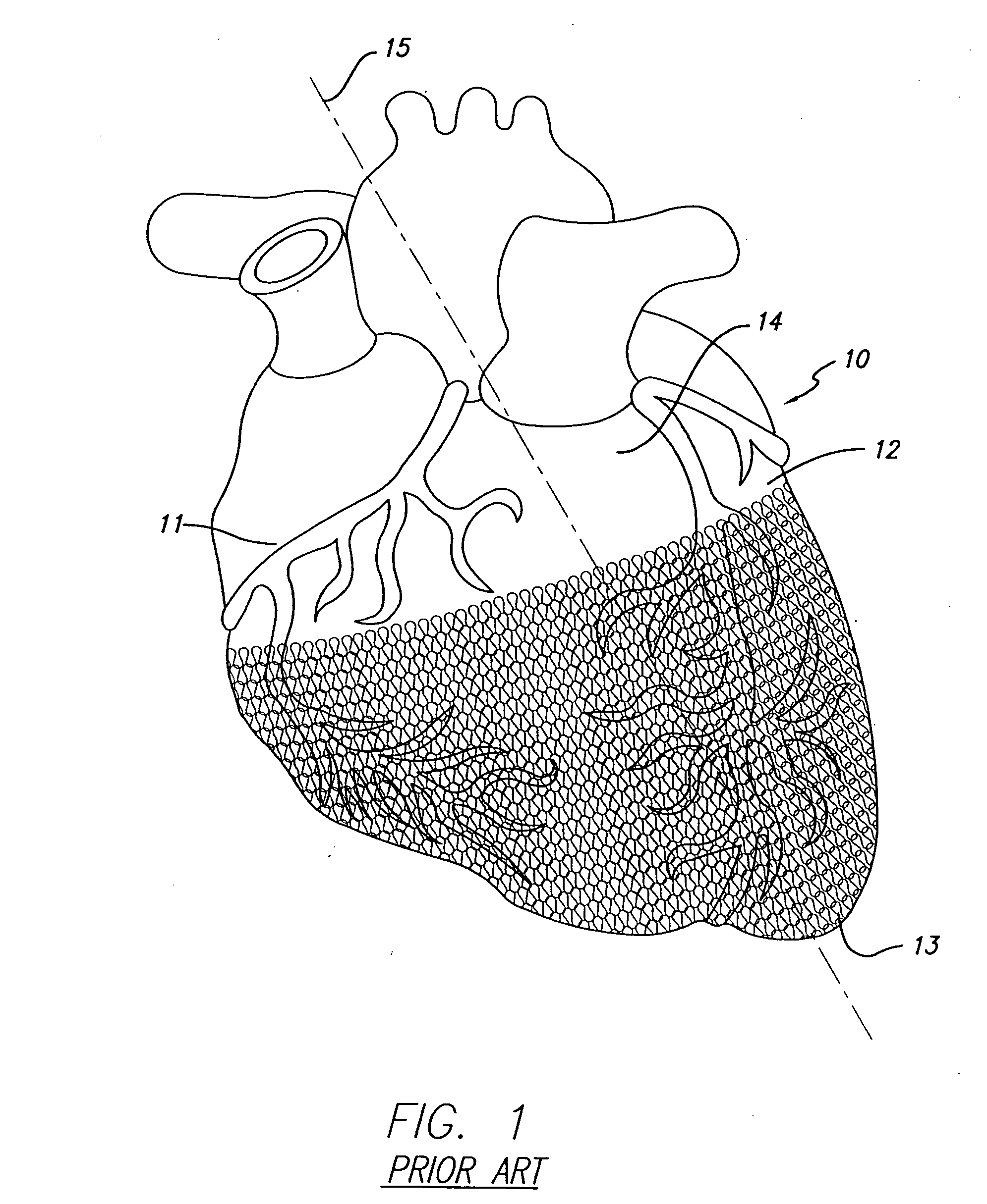 Cardiac harness assembly for treating congestive heart failure and for pacing/sensing