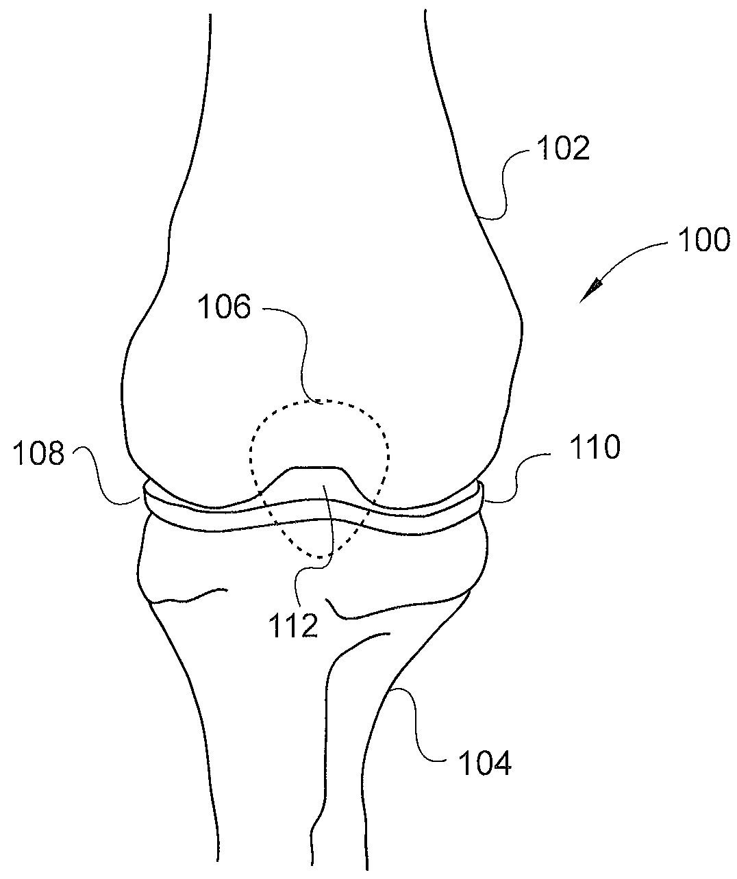 Combinatorial therapy for treatment of osteoarthritis of the knee