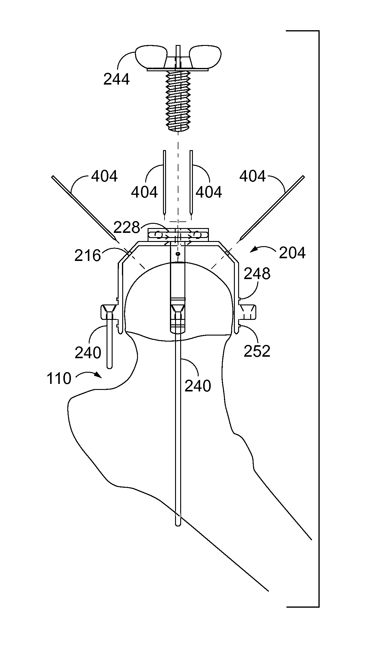 Method and System for Modular Hip Resurfacing