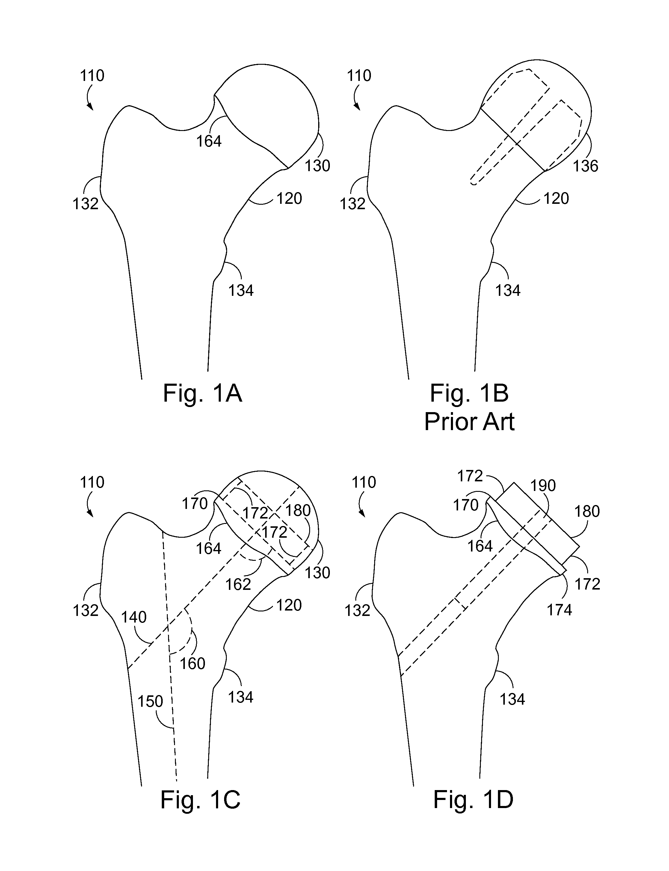 Method and System for Modular Hip Resurfacing