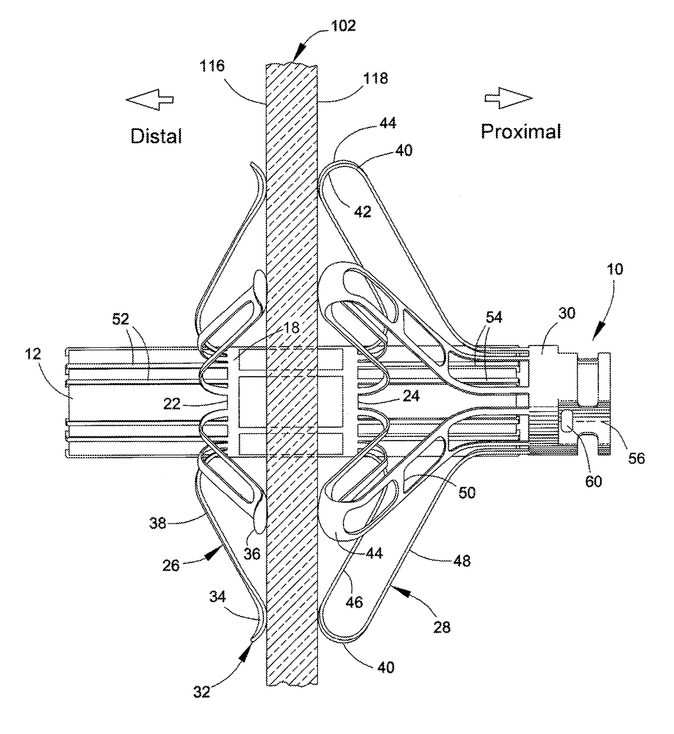 Delivery system, method, and anchor for medical implant placement