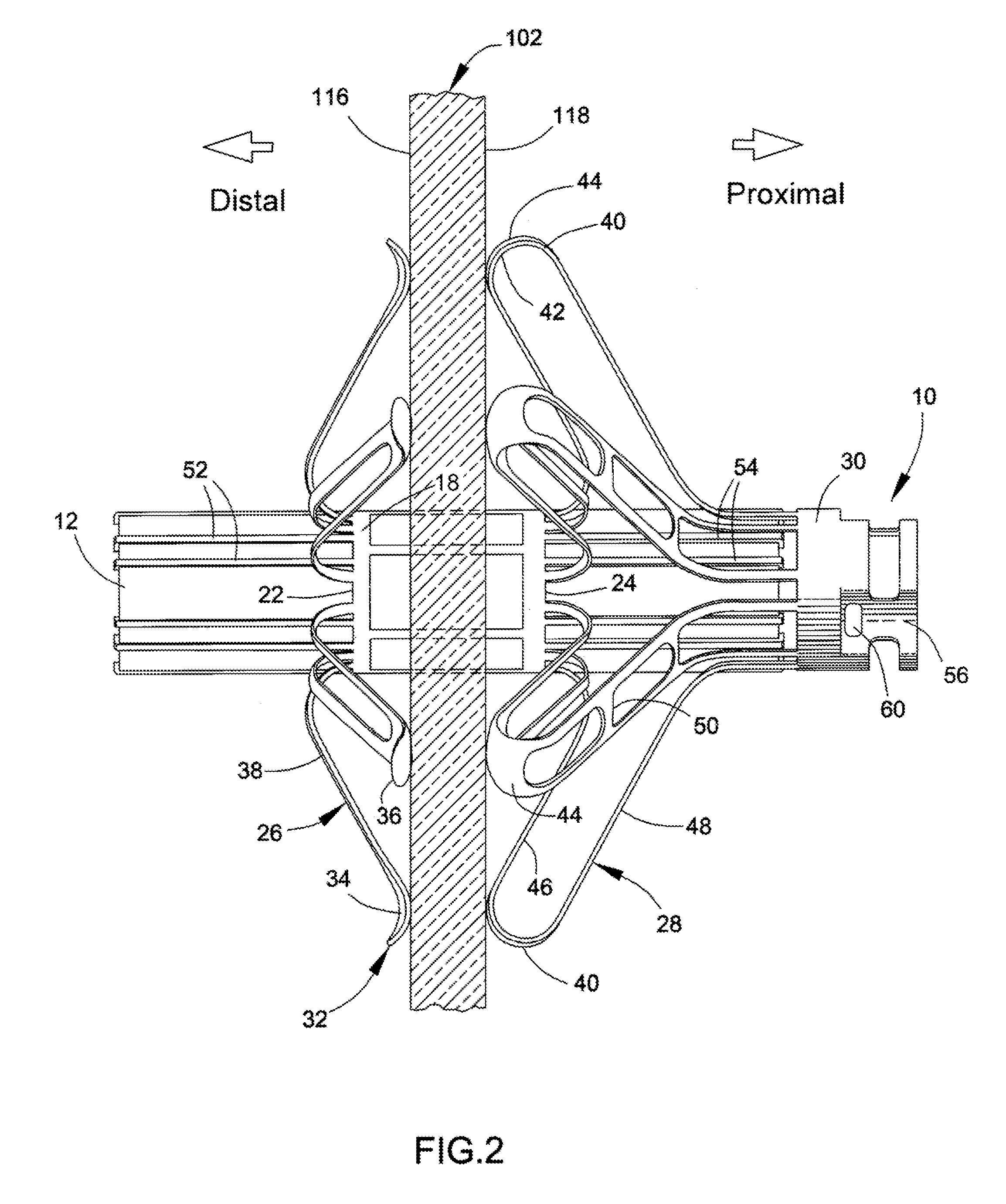 Delivery system, method, and anchor for medical implant placement