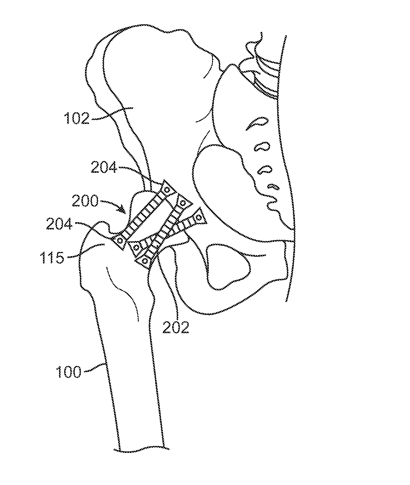 Apparatus for controlling a load on a hip joint