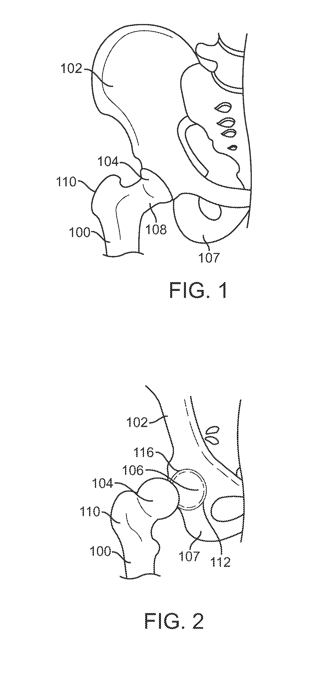 Apparatus for controlling a load on a hip joint