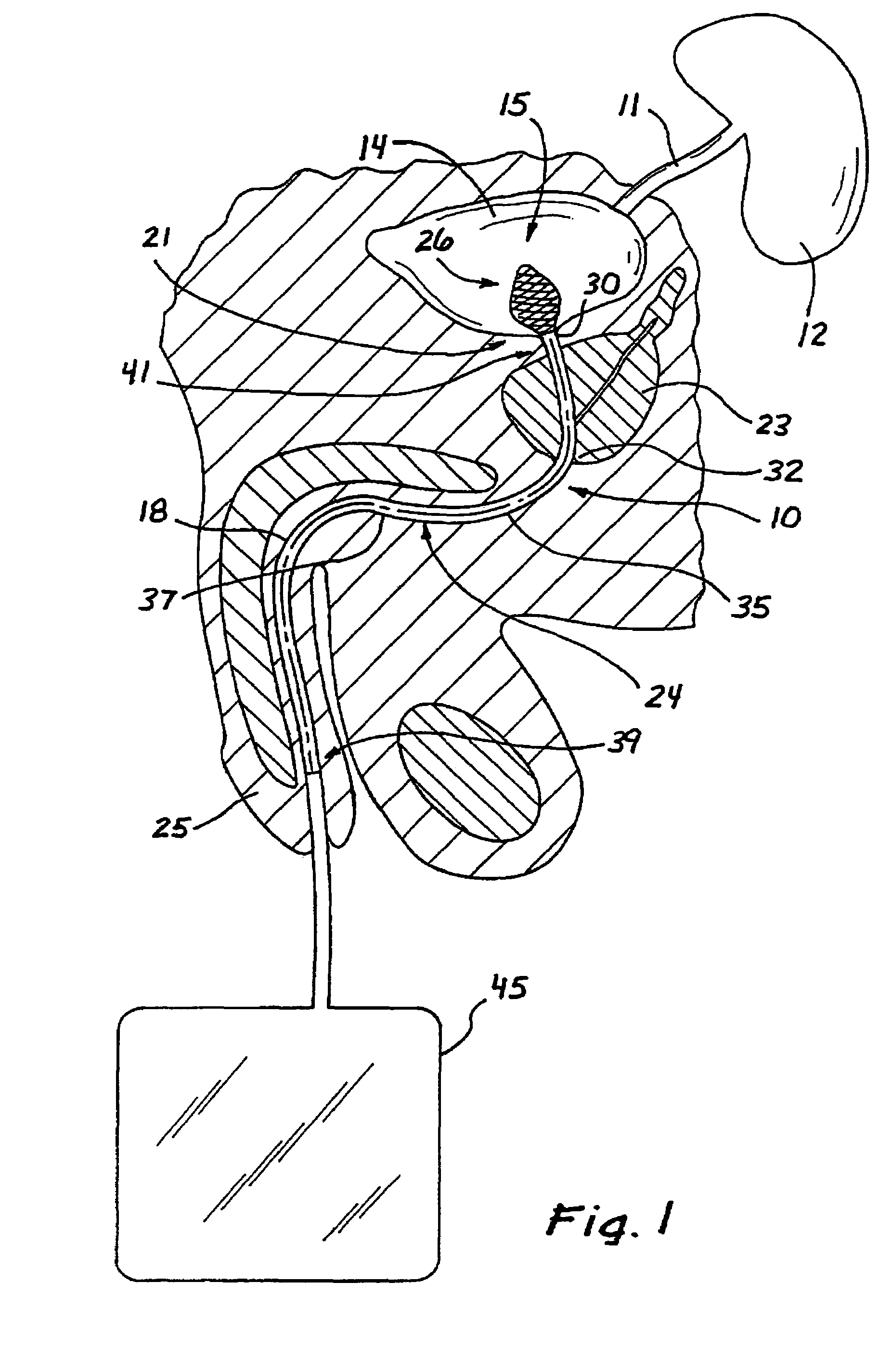 Drainage catheter having an expandable retention member