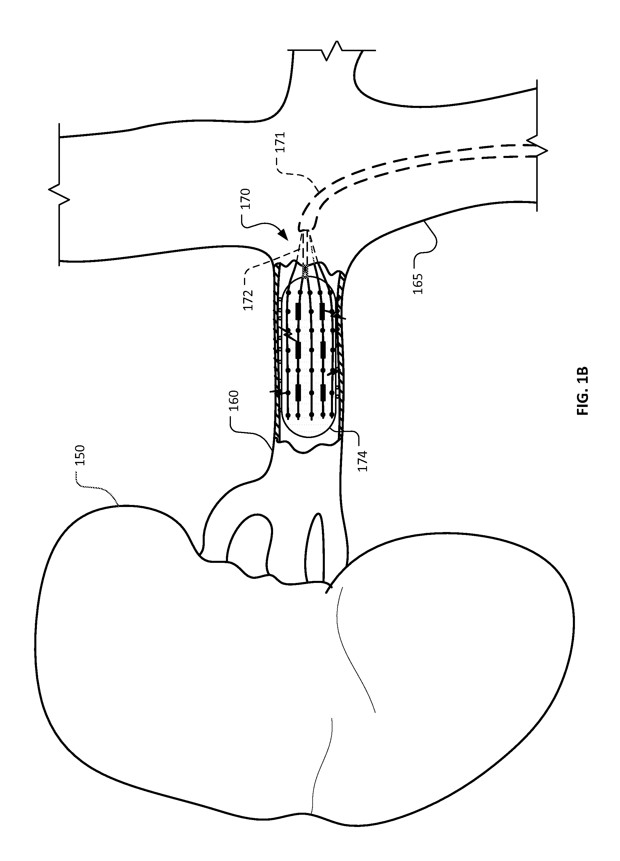 Devices and methods for ablation of tissue