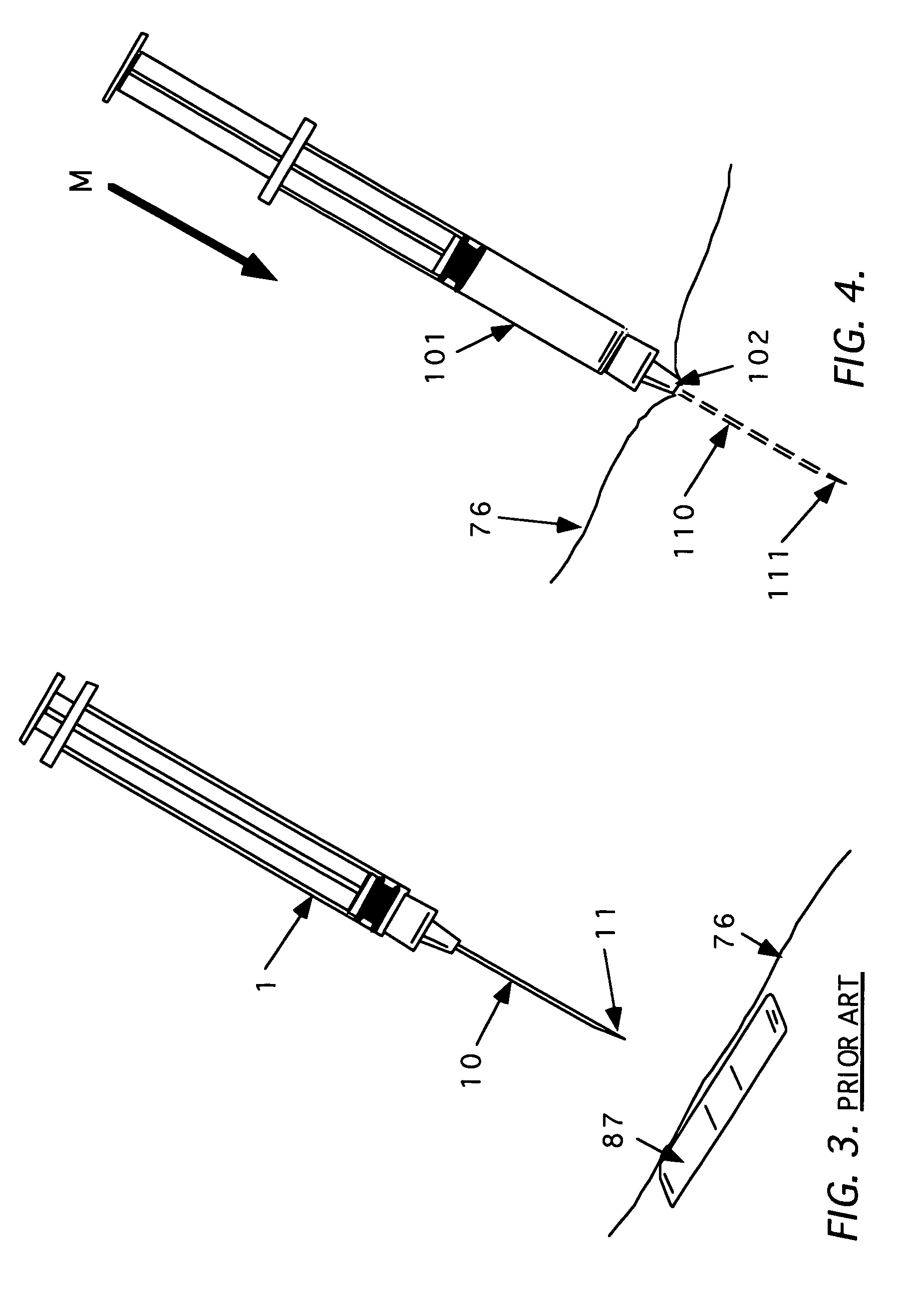 Method and apparatus for indicating or covering a percutaneous puncture site