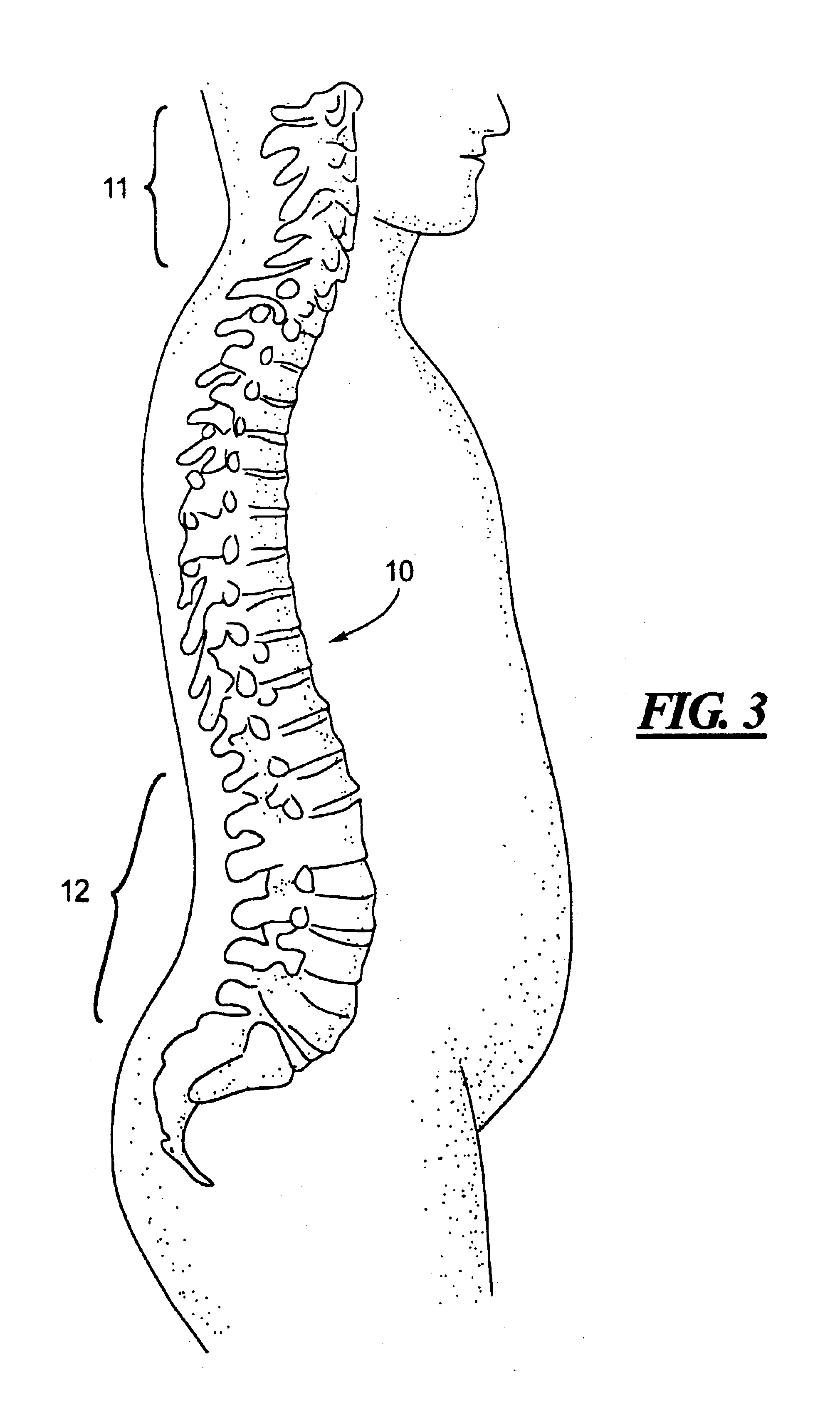 Method for lordosis adjustment for treating discomfort in, or originating in, the cervical spine region