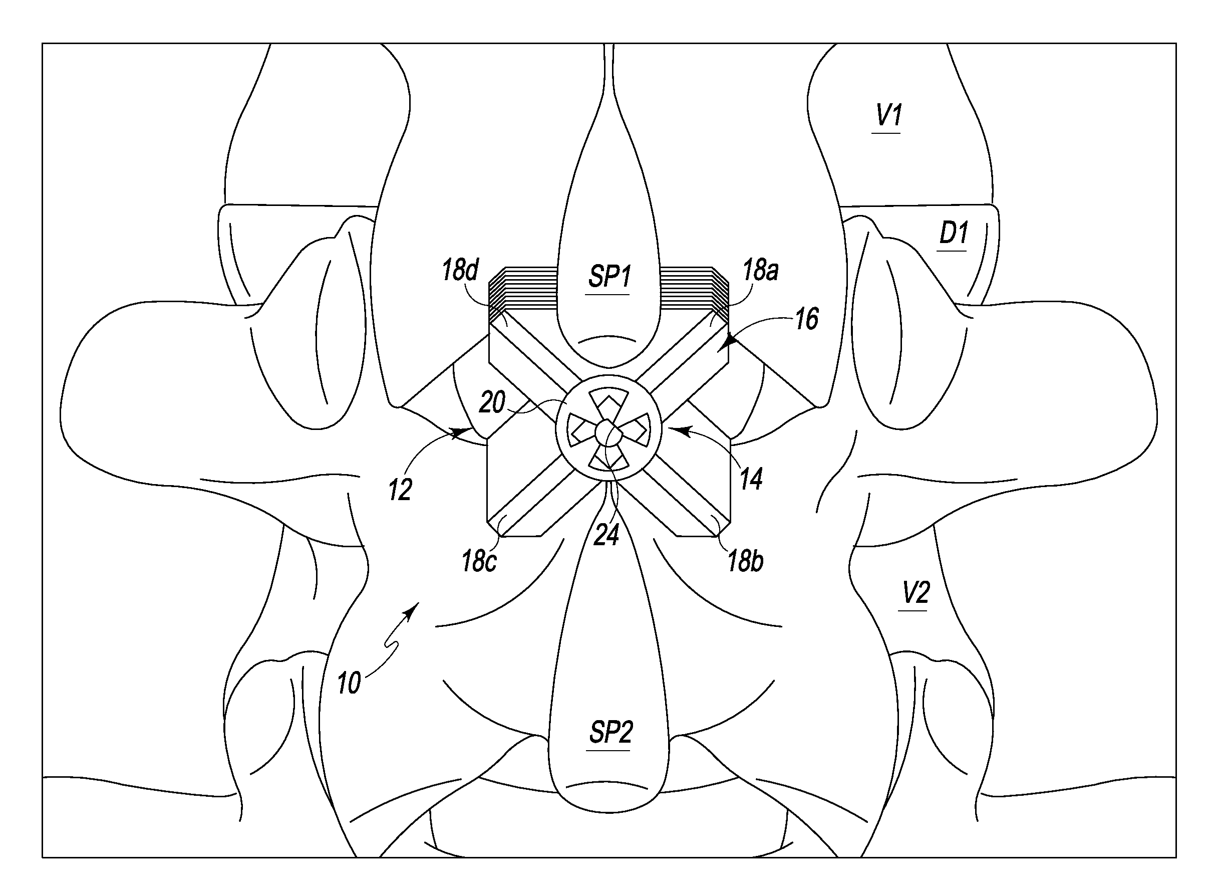 Spinous Process Spacer