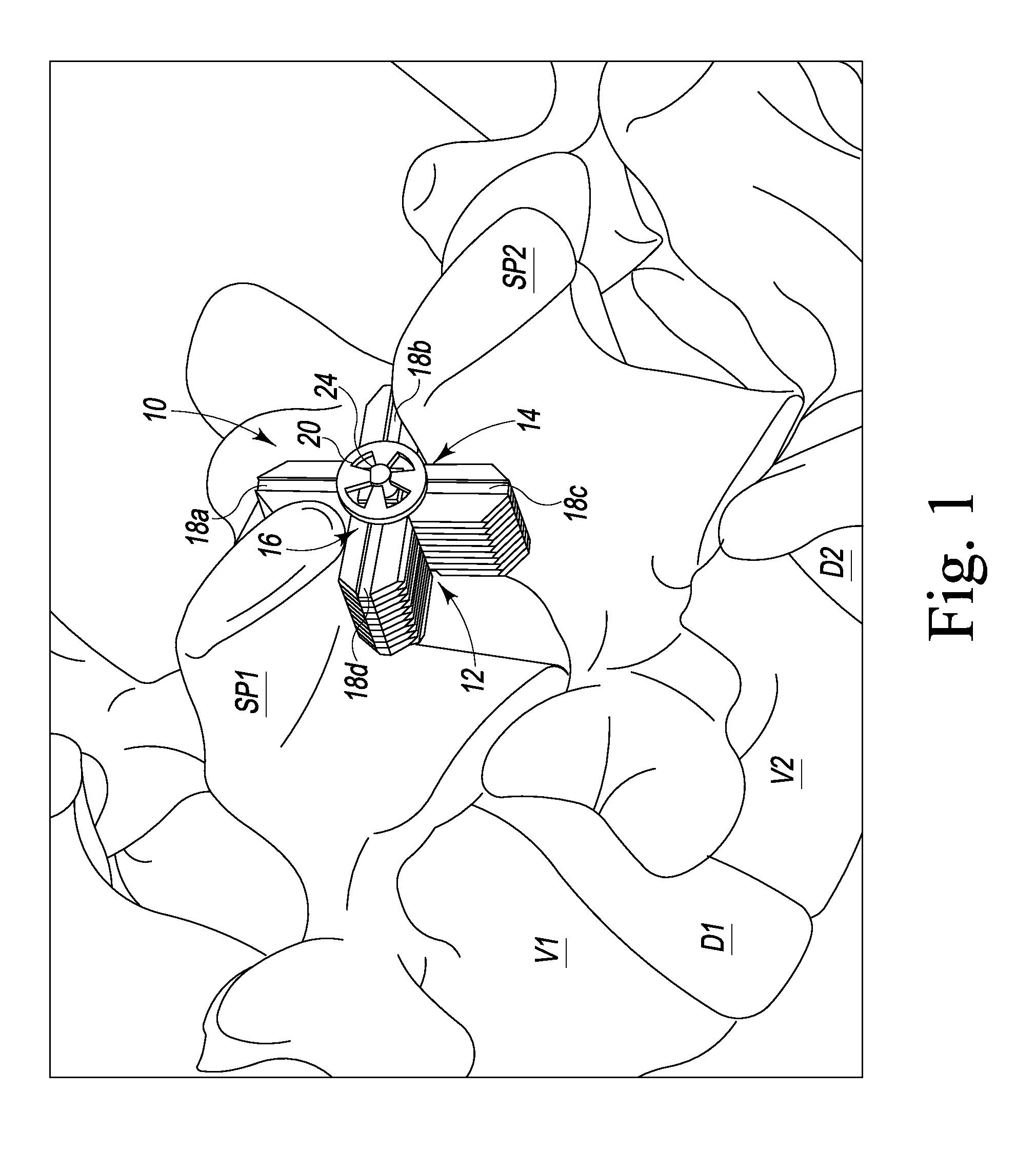 Spinous Process Spacer