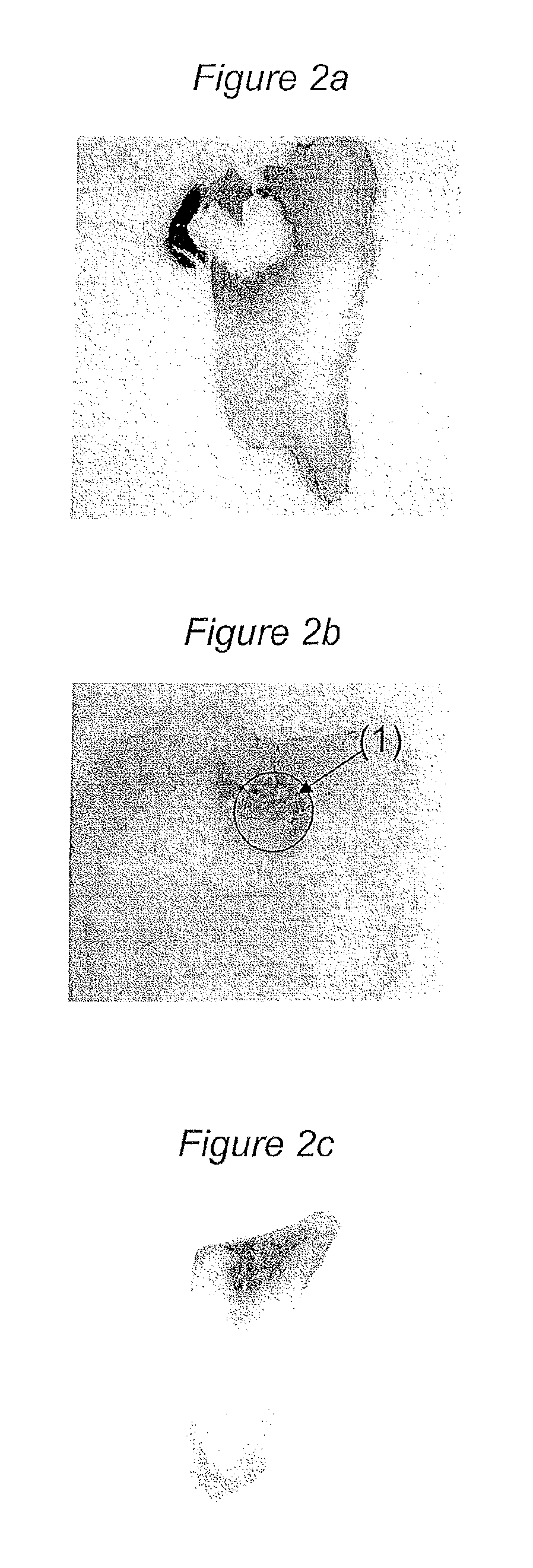 Detection and removal of carious dentin tissue