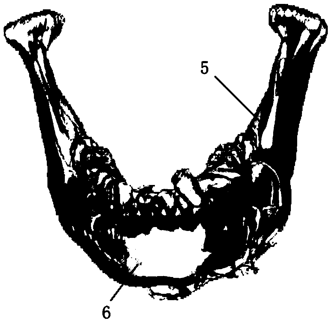 Mandible body bone movement kit based on mandible three-dimensional database matching and preparation method thereof