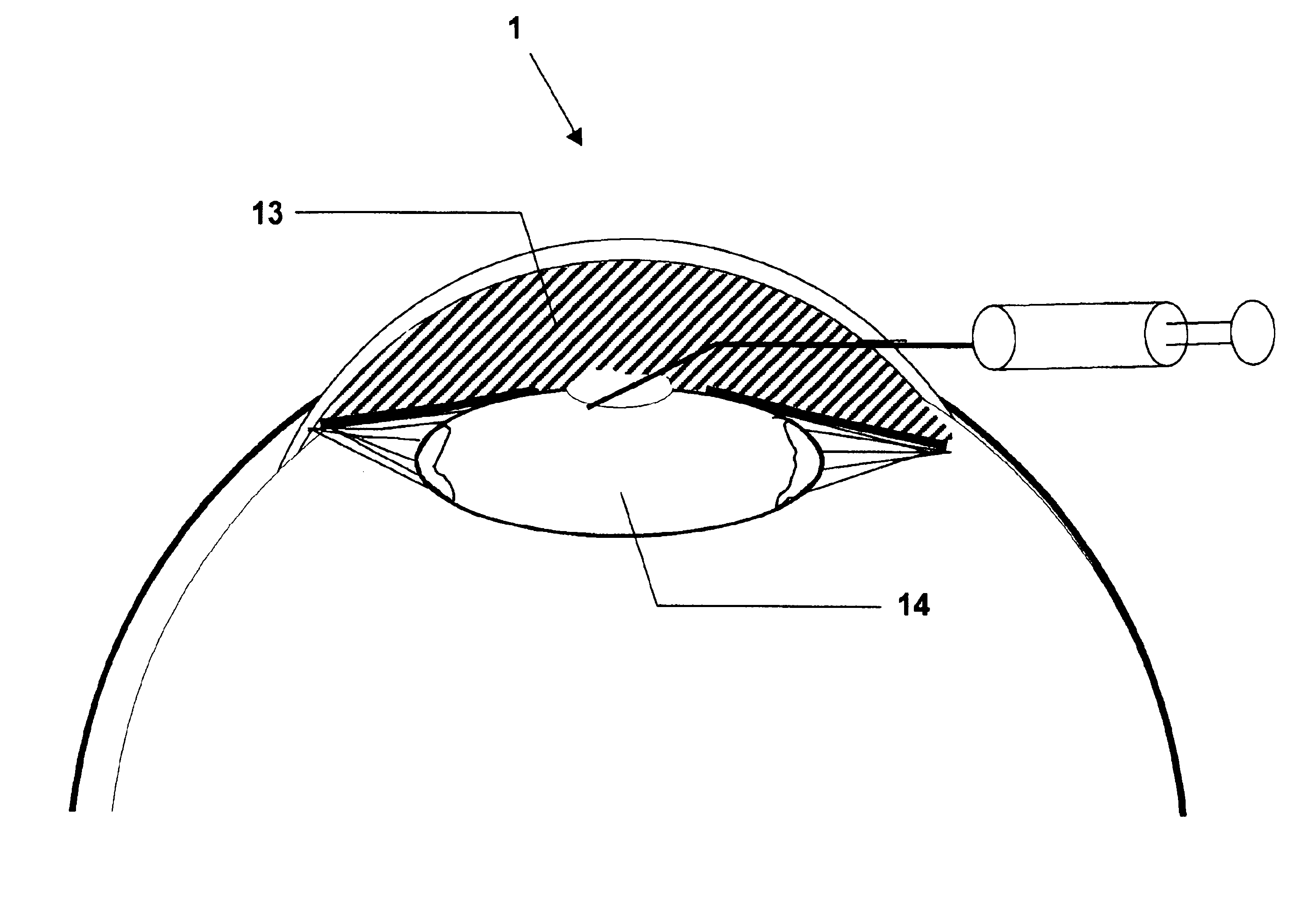 Methods and compositions usable in cataract surgery