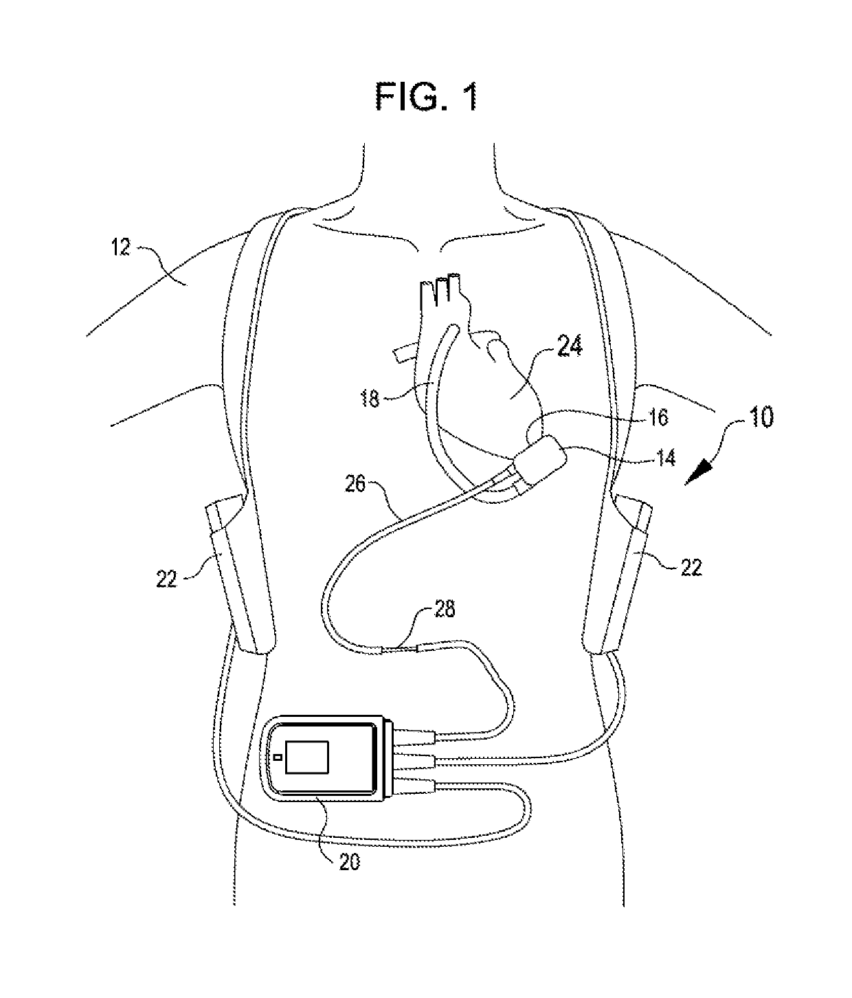 Bearingless implantable blood pump