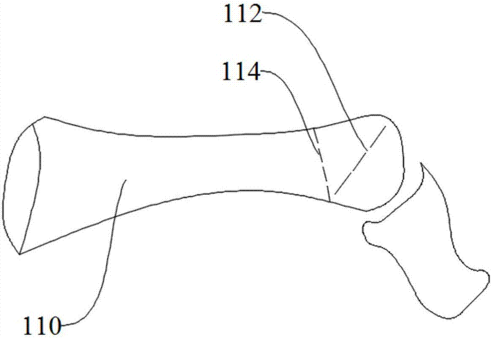 Osteotomy orthopedic guide plate and its manufacturing method