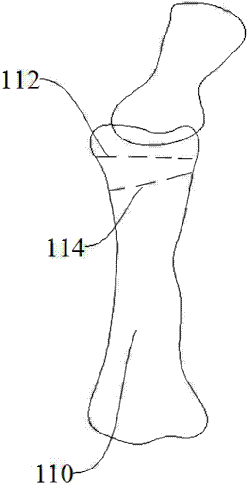 Osteotomy orthopedic guide plate and its manufacturing method