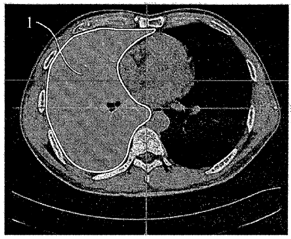 Method for distinguishing pulmonary artery and pulmonary vein, and method for quantifying blood vessels using same