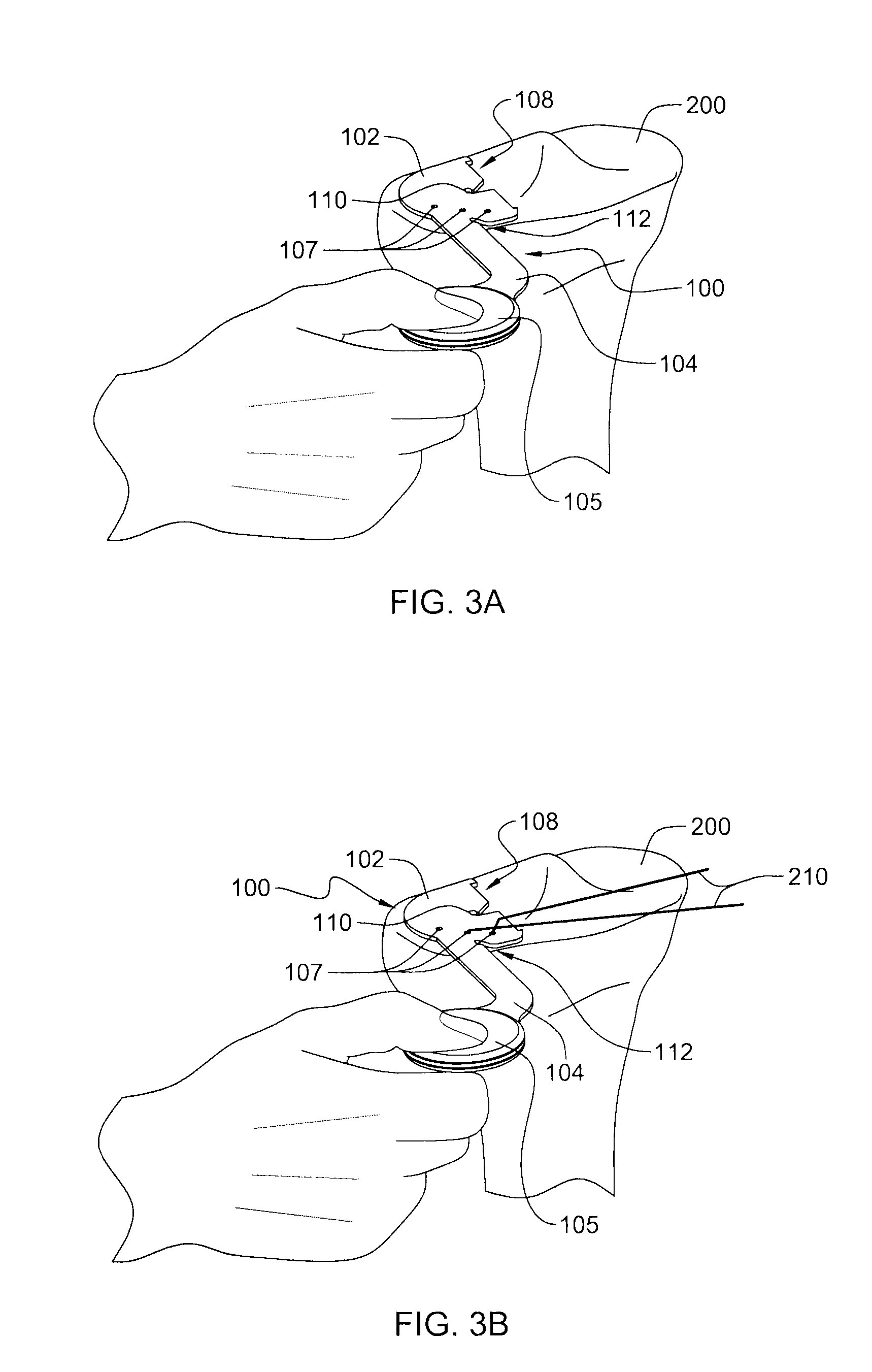 Implant guide and method of use