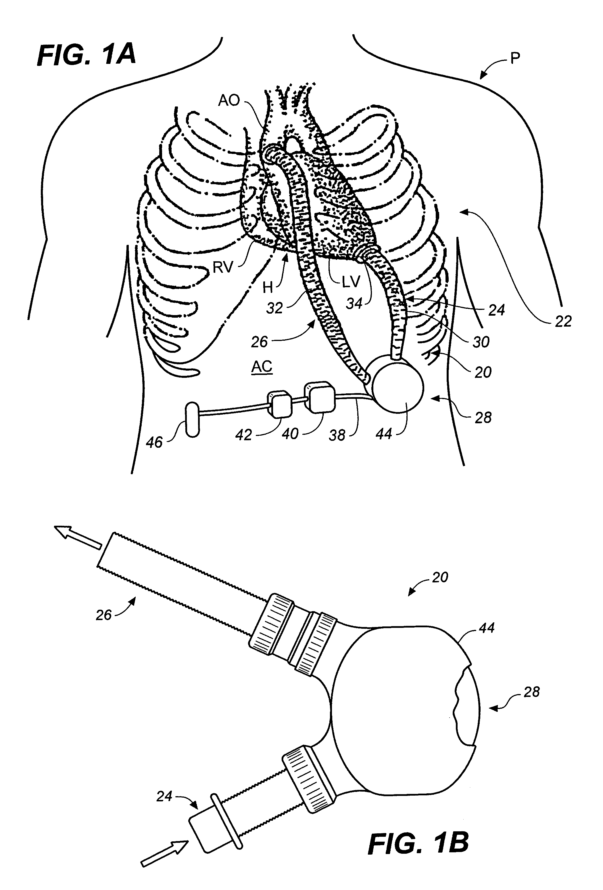 Miniature, pulsatile implantable ventricular assist devices and methods of controlling ventricular assist devices