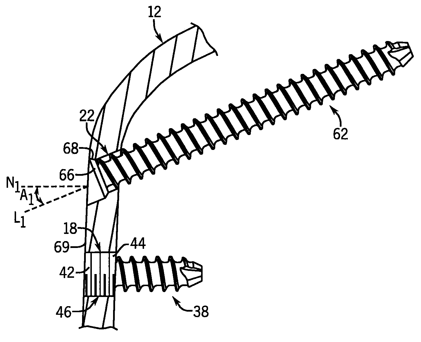 Joint Fixation System For the Hand