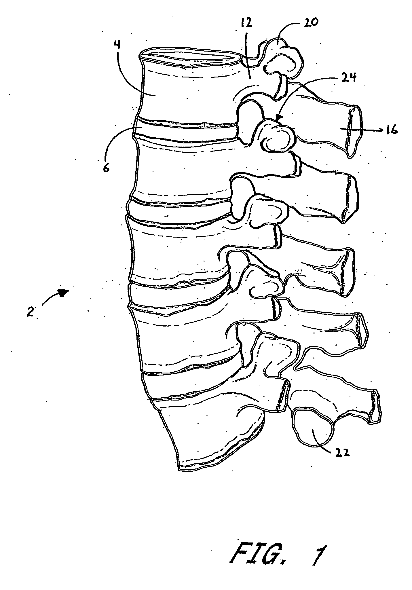 Side-biased orthopedic fastener retention