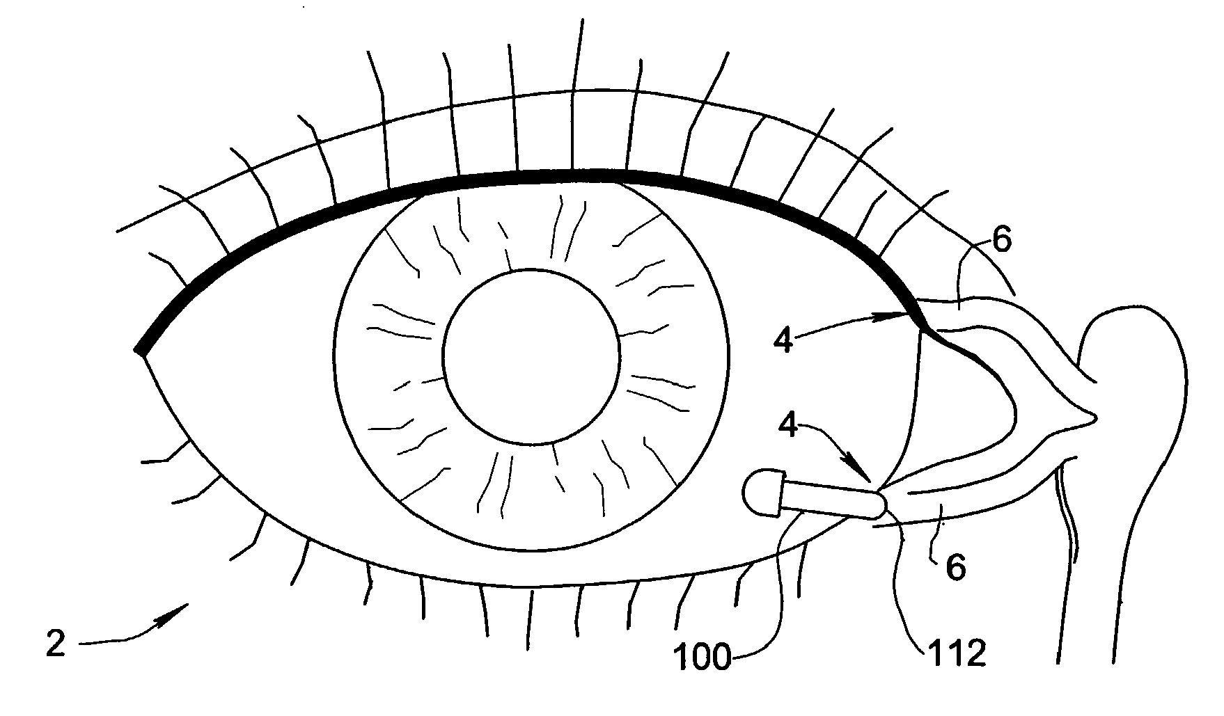 Treatment Medium Delivery Device and Methods for Delivery of Such Treatment Mediums to the Eye Using such a Delivery Device