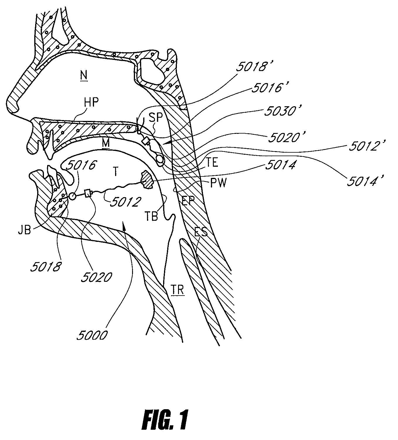 Airway implants and methods and devices for insertion and retrieval