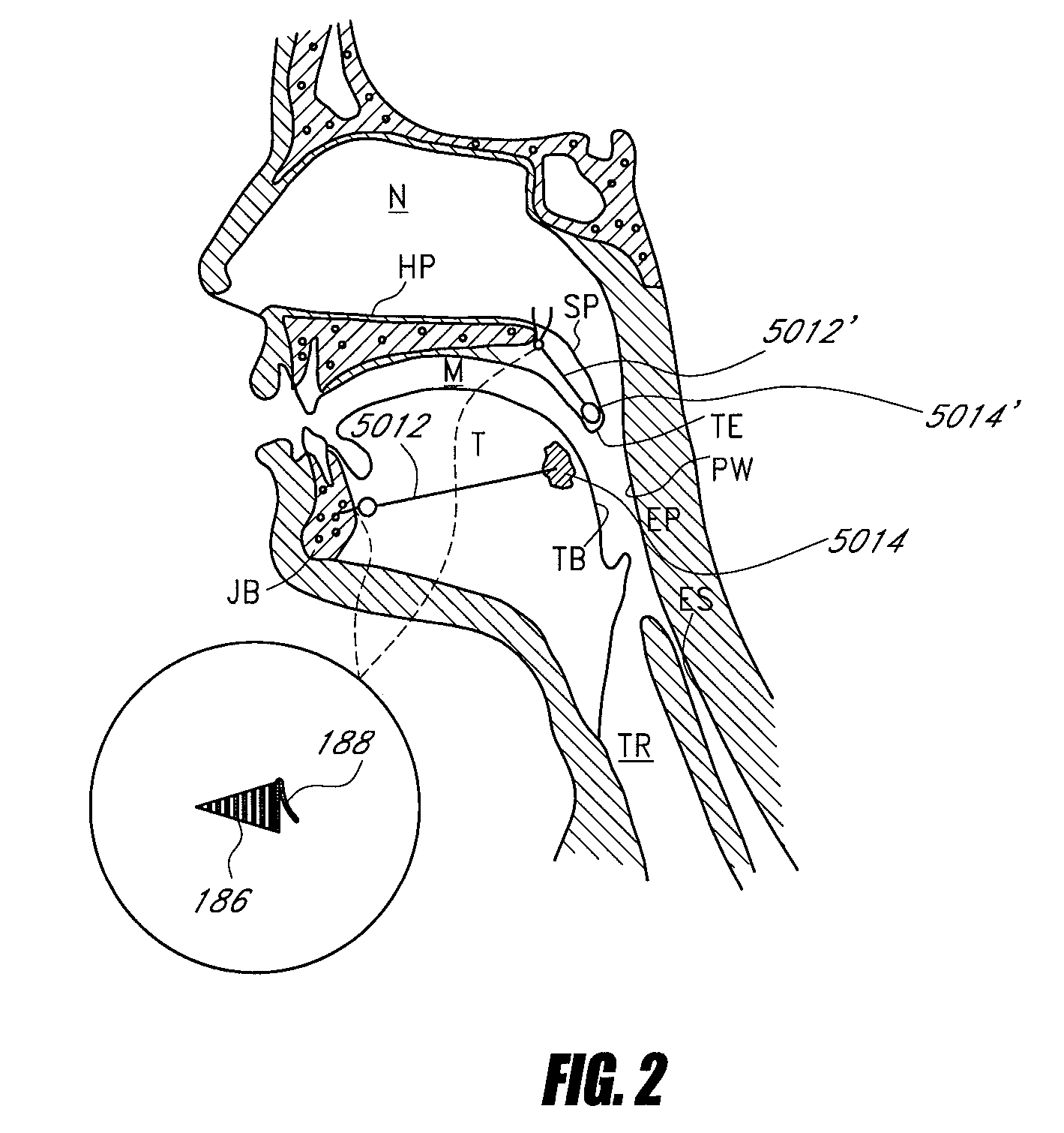 Airway implants and methods and devices for insertion and retrieval