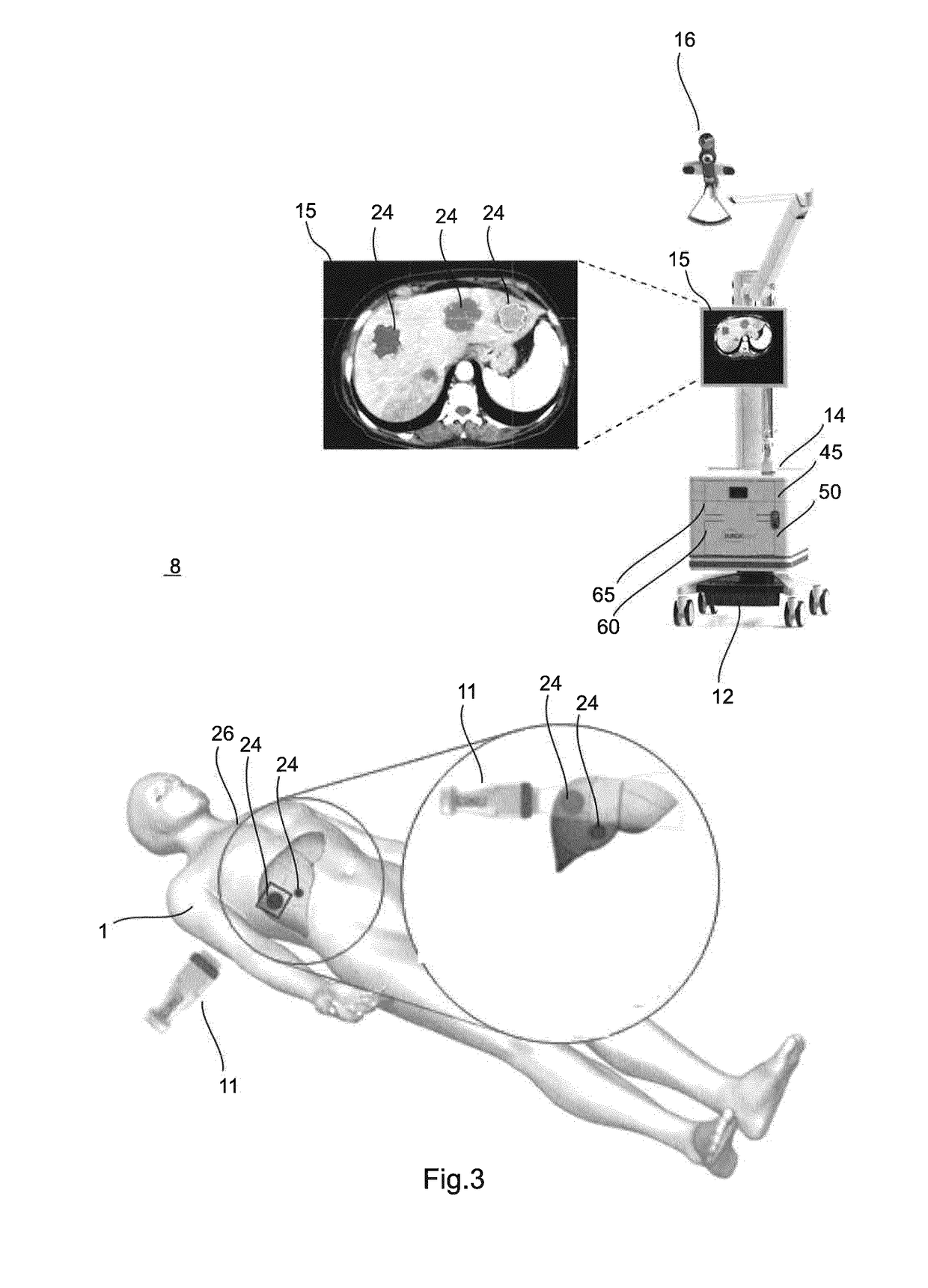 System and method for the determination of a dose in radiotherapy