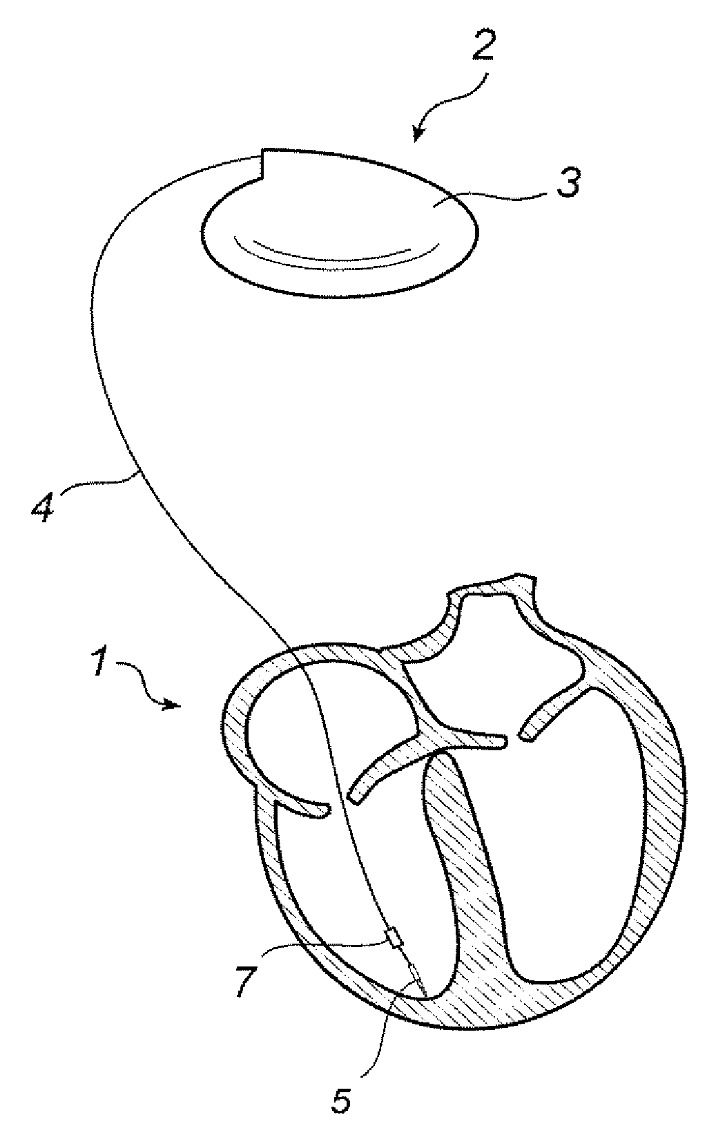 Implantable Lead with a Stimulating Electrode and a Mapping Electrode that is Electrically Disconnectable