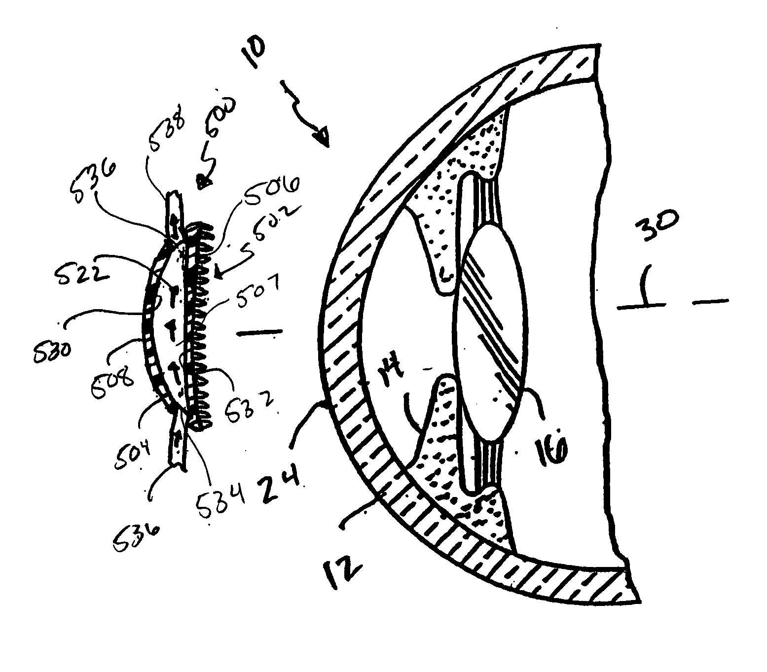 Method and apparatus for reshaping the cornea by controlled thermal delivery