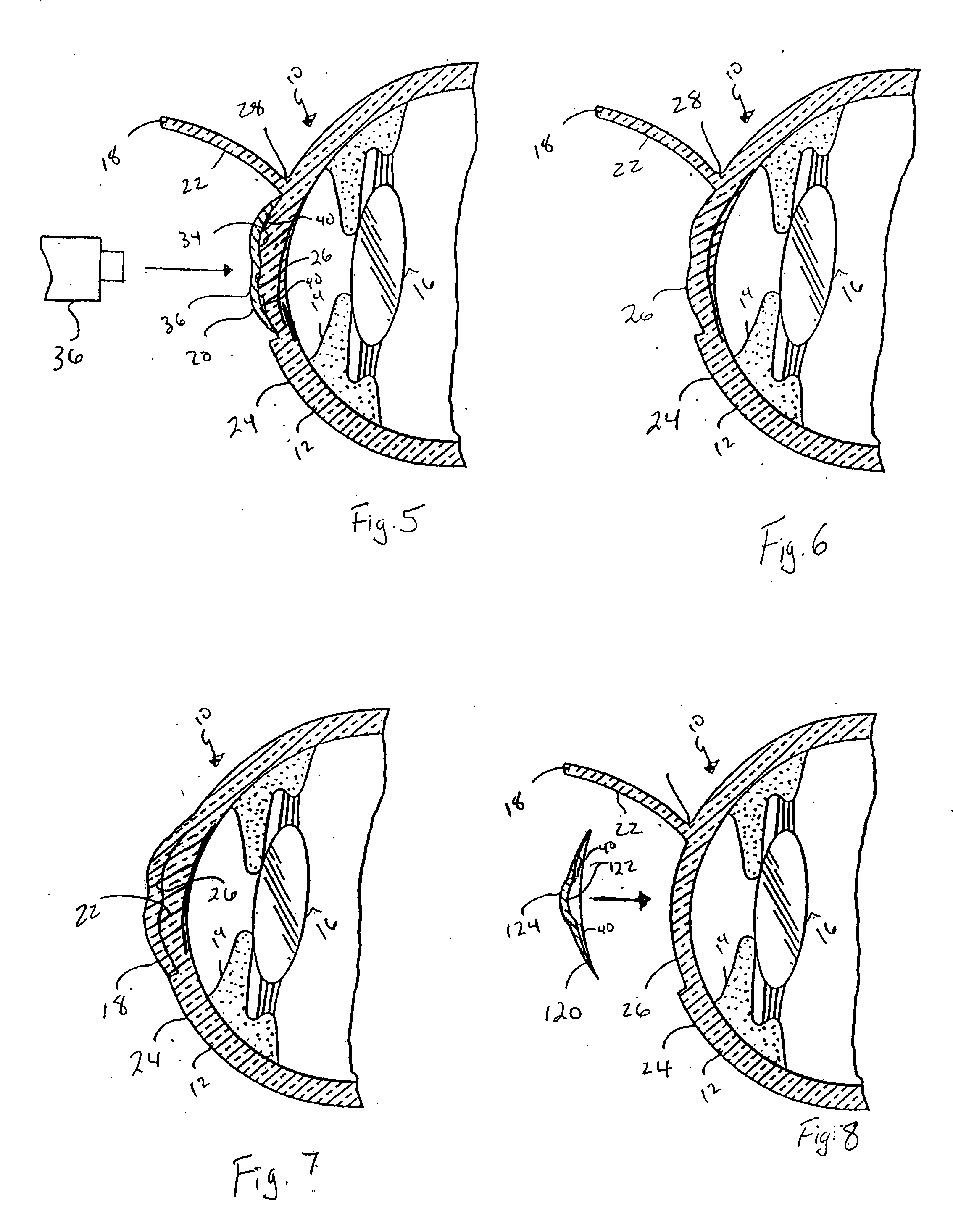 Method and apparatus for reshaping the cornea by controlled thermal delivery