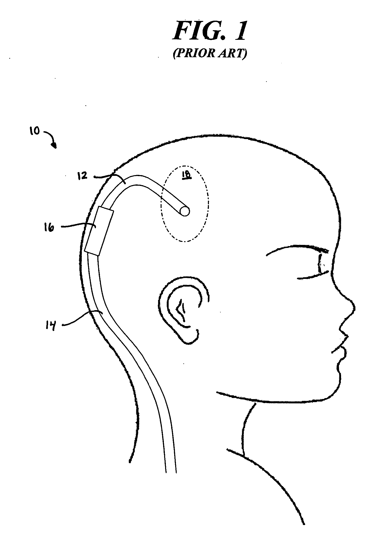 High pressure range hydrocephalus valve system