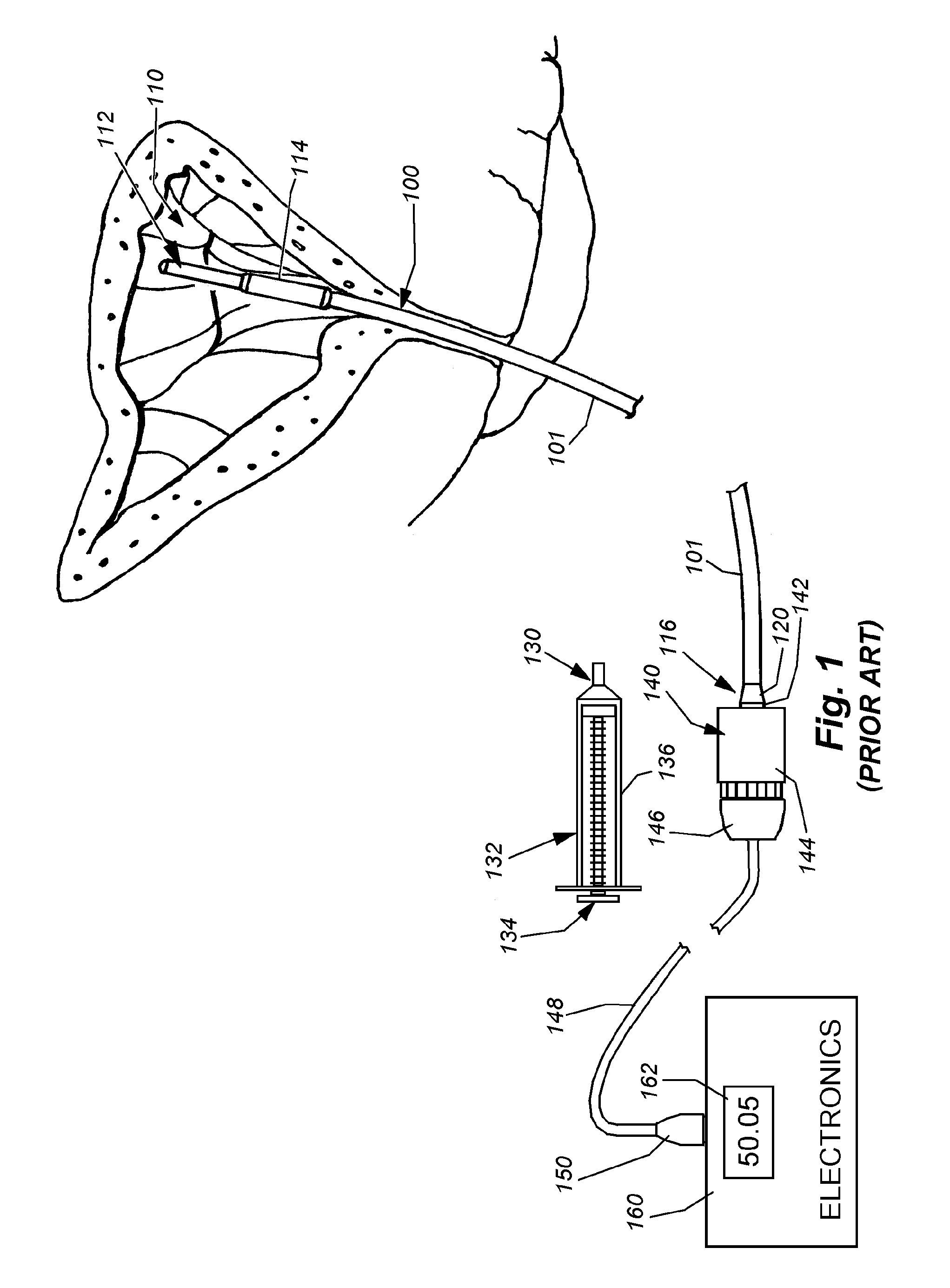 Pressure sensing catheter