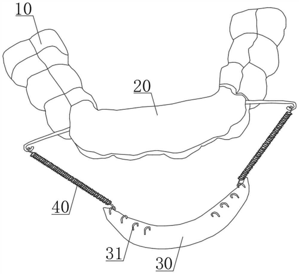 Invisible appliance for lowering mandibular anterior teeth