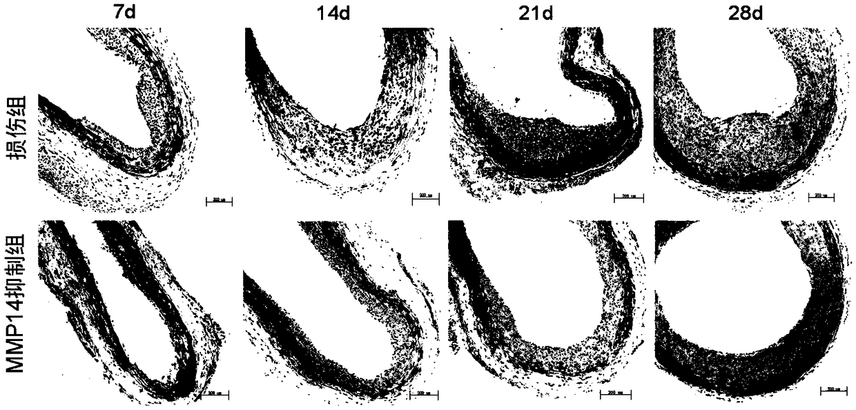 Application of MMP-14 inhibitor in preparation of medicines for treating blood vessel injury